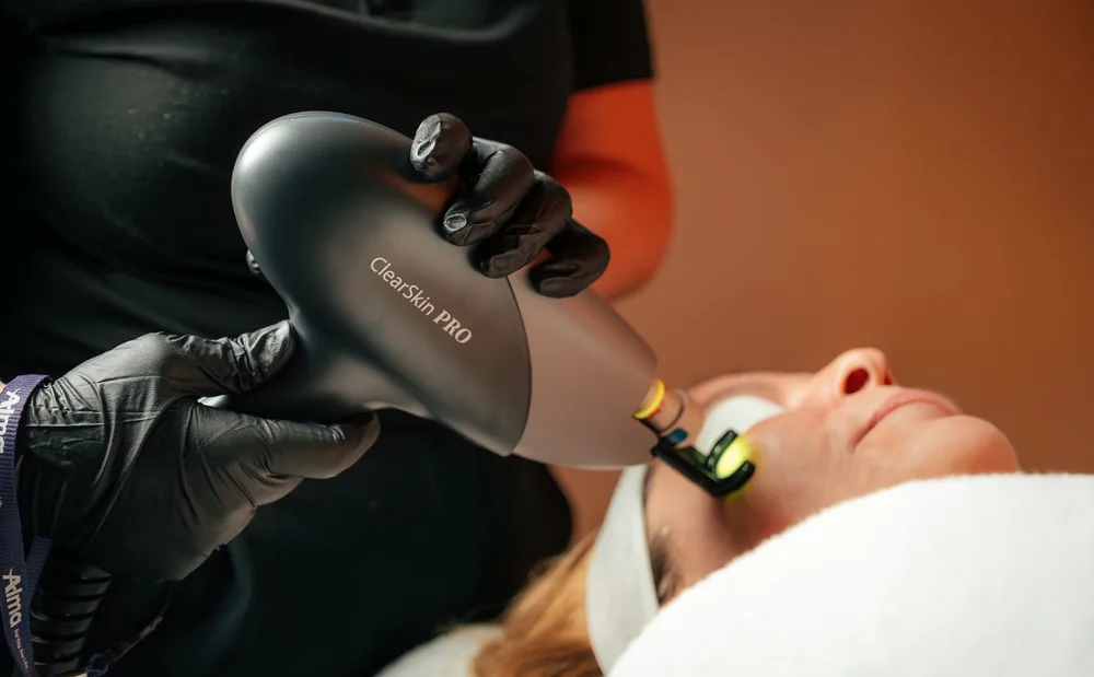 ClearSkin Pro laser rejuvenation