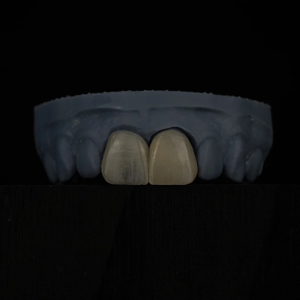 Carilla y corona disilicato e.max CAD
#veneers #dentallab #carillas #dentallaboratory #laboratoriodentalmadrid #clinicadentalmadrid