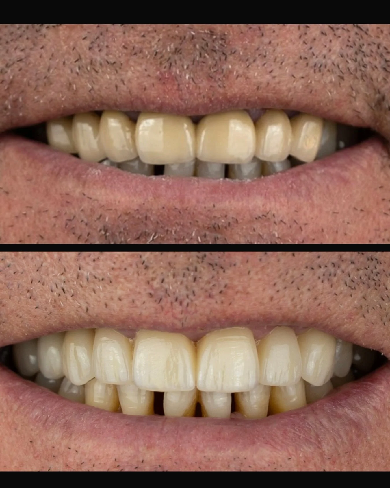 New smile😀

#dentaltechnician #dentalhealth #laboratoriodental #laboratoriodentalespa&ntilde;a #protesisdentales #clinicadental