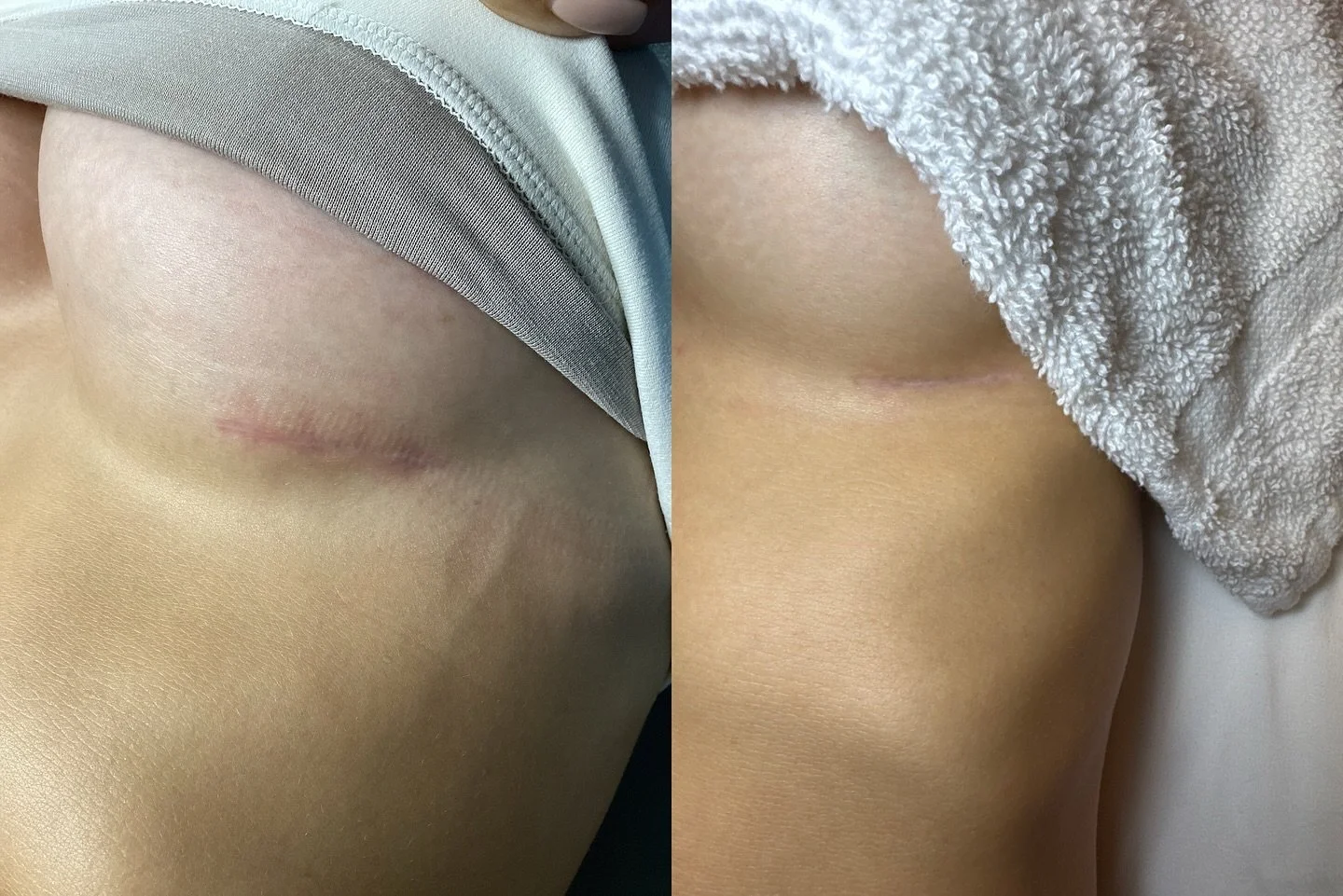 Breast Augmentation Scar Improvement &mdash; after one treatment! We moved on to treating texture this time, since the redness is much improved 😃 

🕵️ Ask us how we can improve your surgical scars!

Our clinic is designed to serve you corrective an