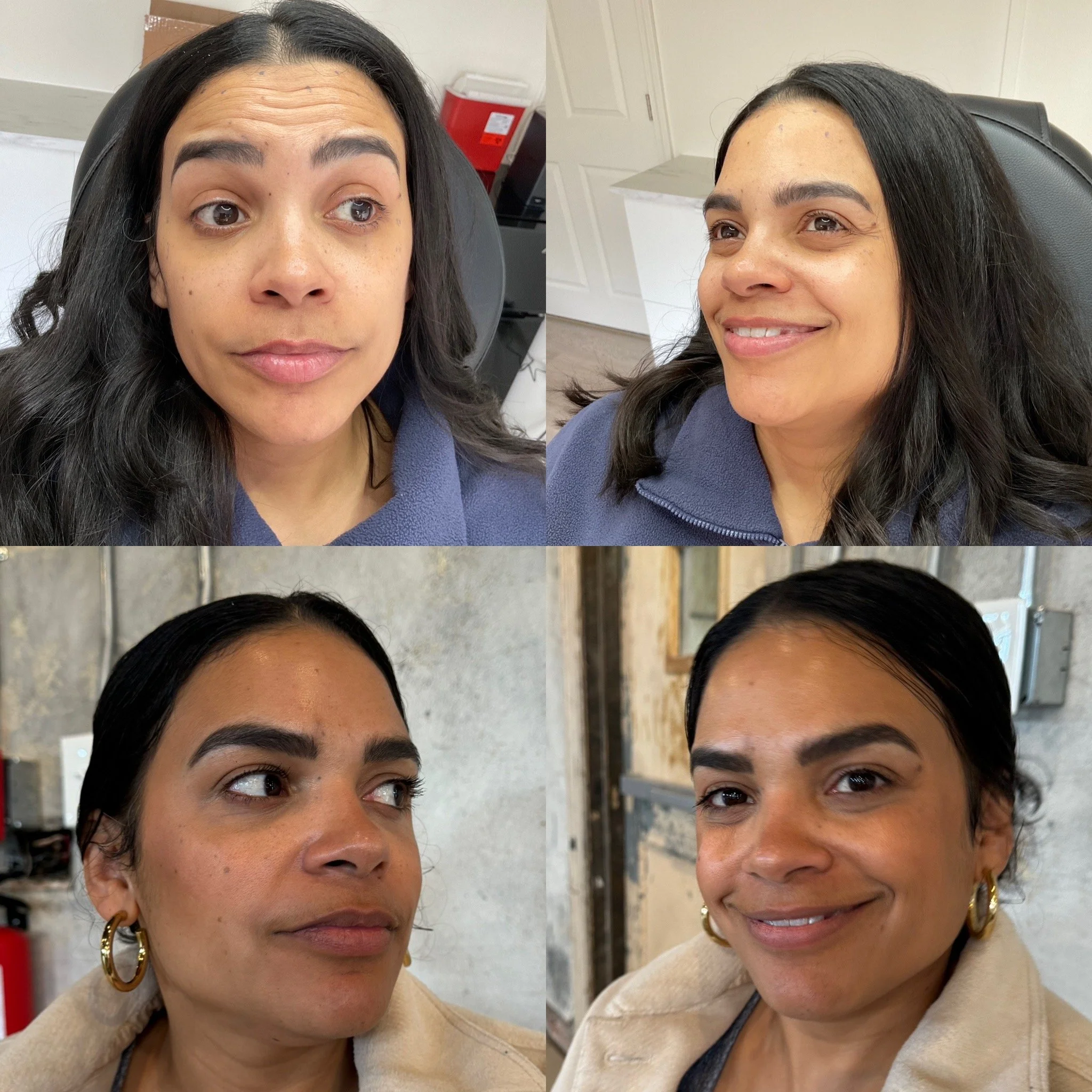 Botox