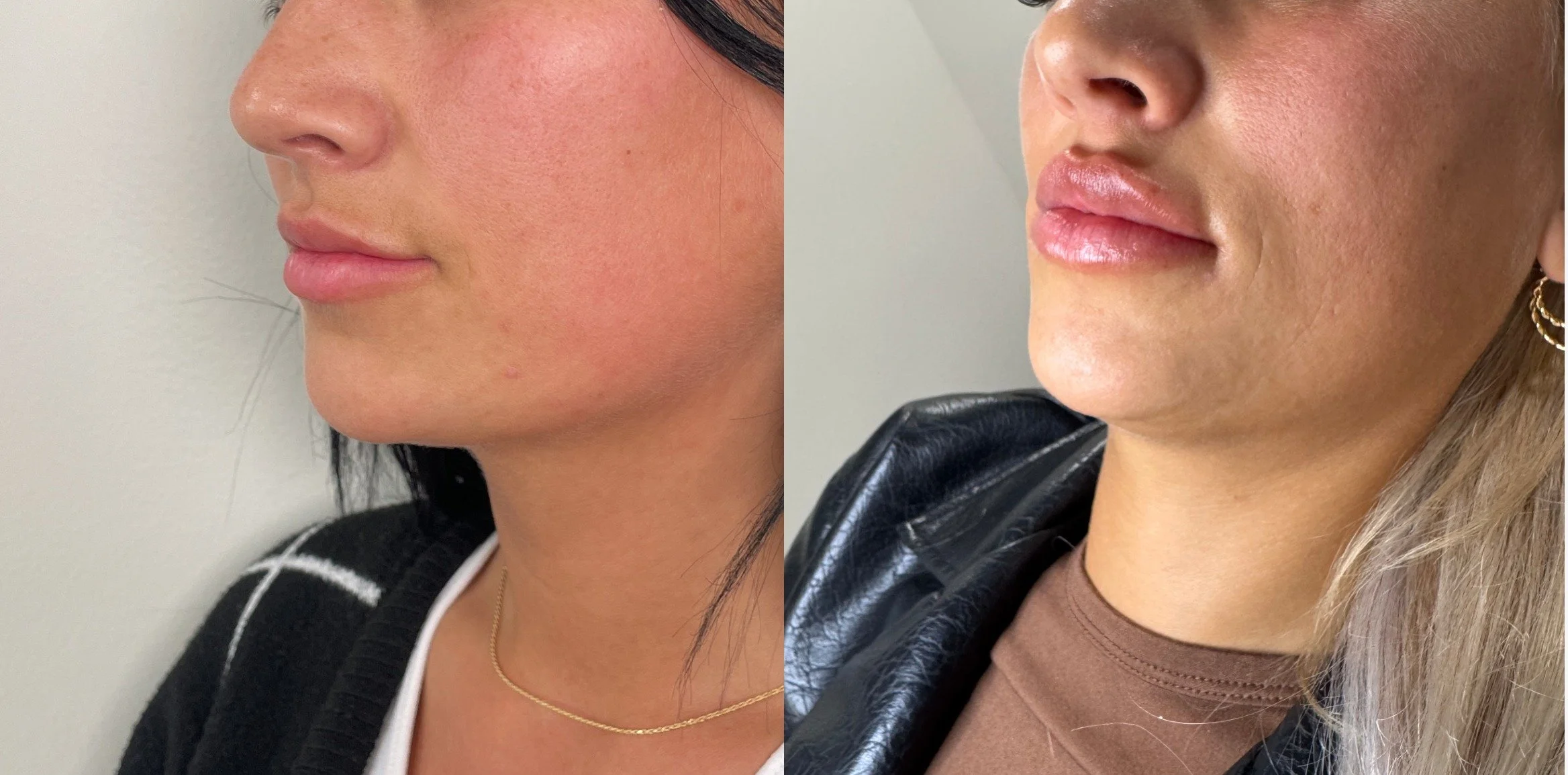 lip filler 2c.jpg_IMG_4735.jpeg_1754408475317comparison.jpeg