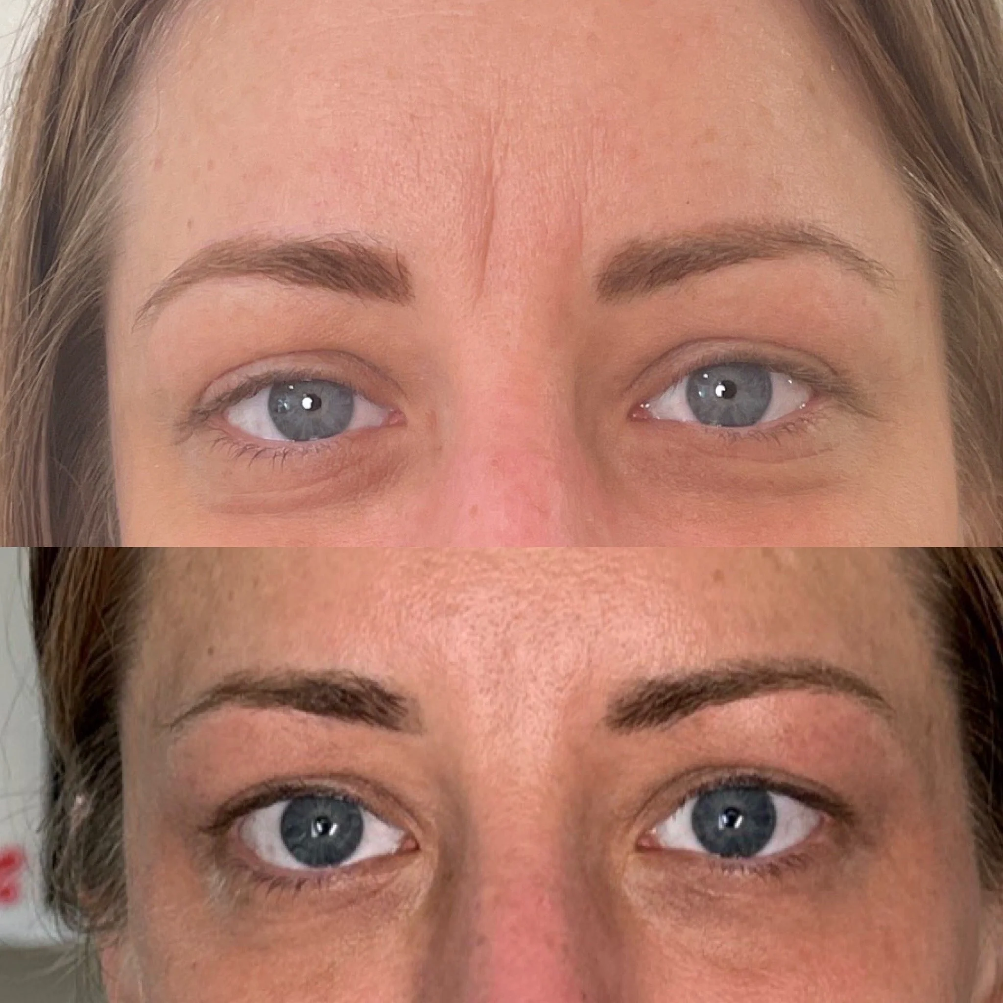 Botox for Frown Lines