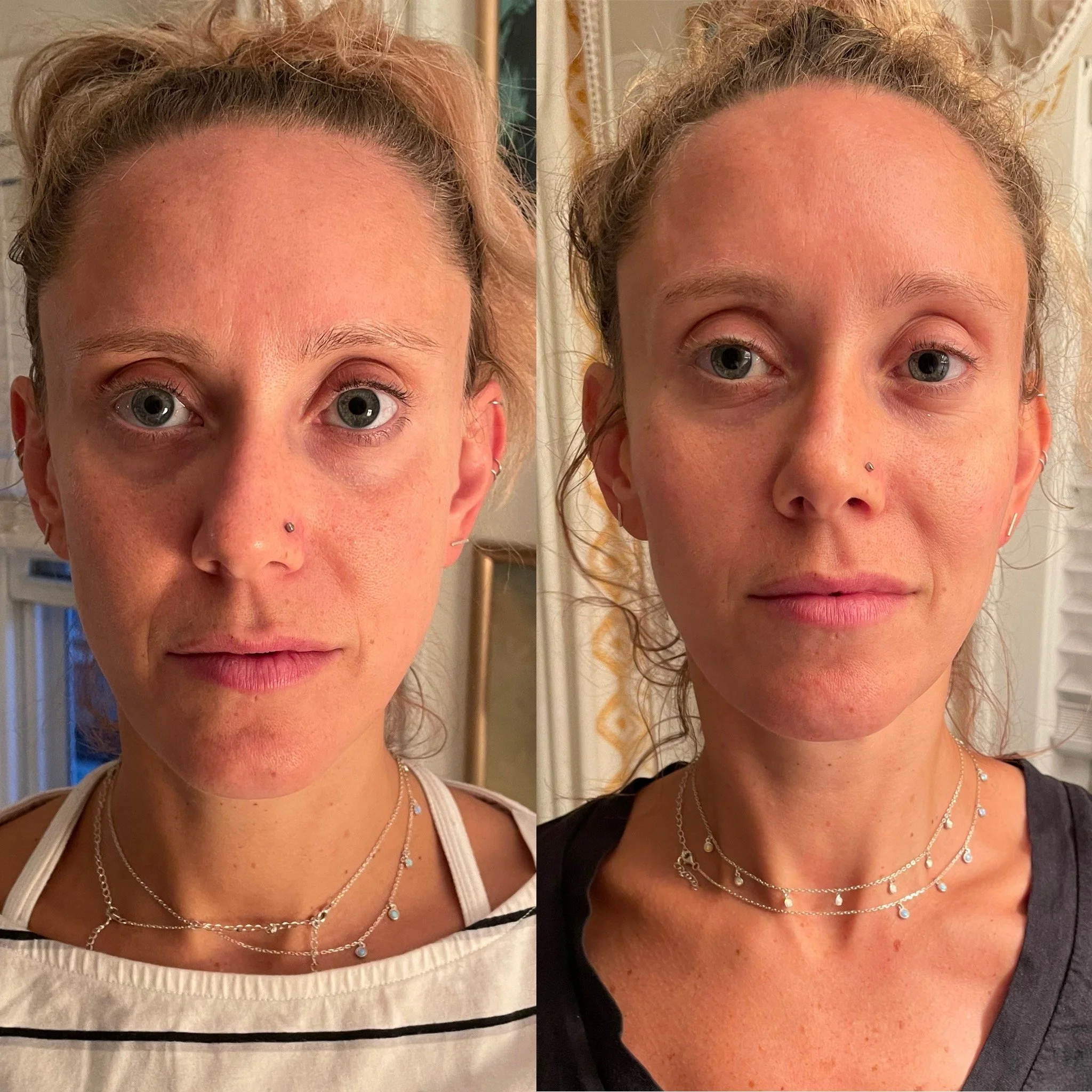 Cheek Filler
