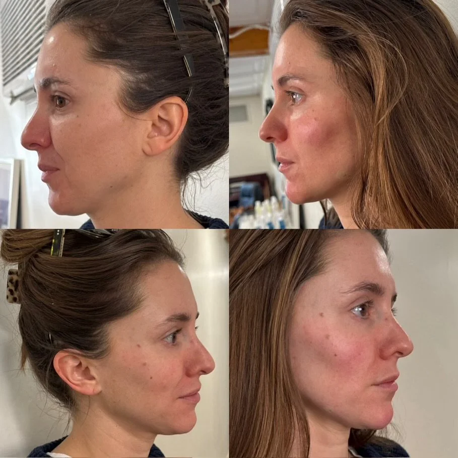 Full Face Filler