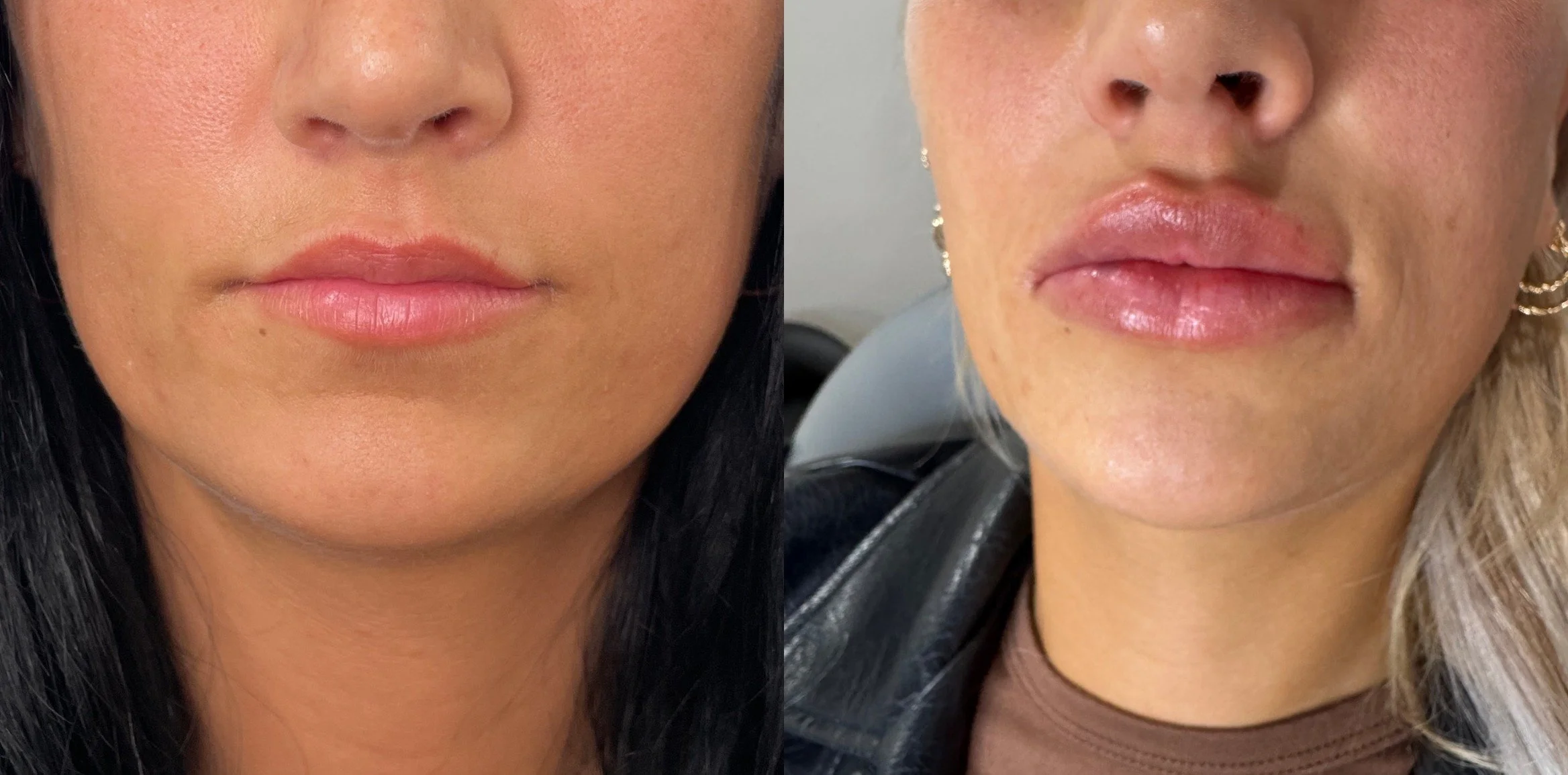 lip filler b.jpg_IMG_4734.jpeg_1754408450830comparison.jpeg