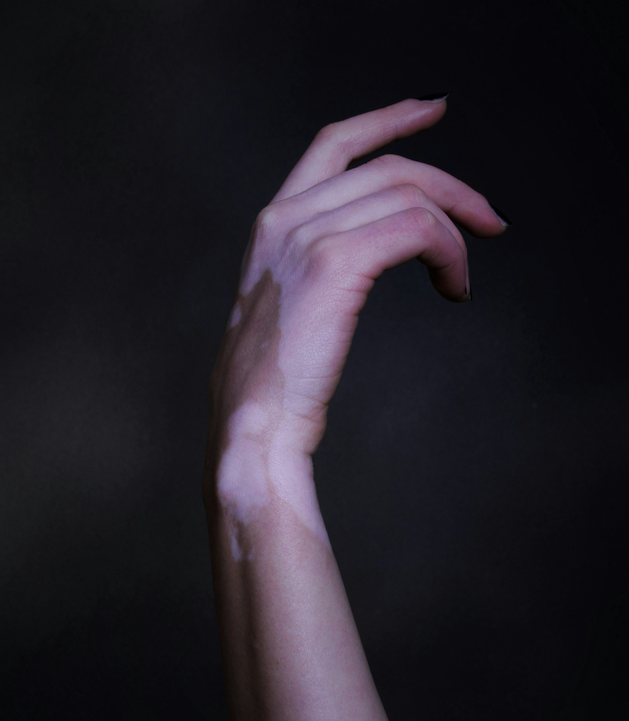 (17, WA, USA) Anonymous - Vitiligo 