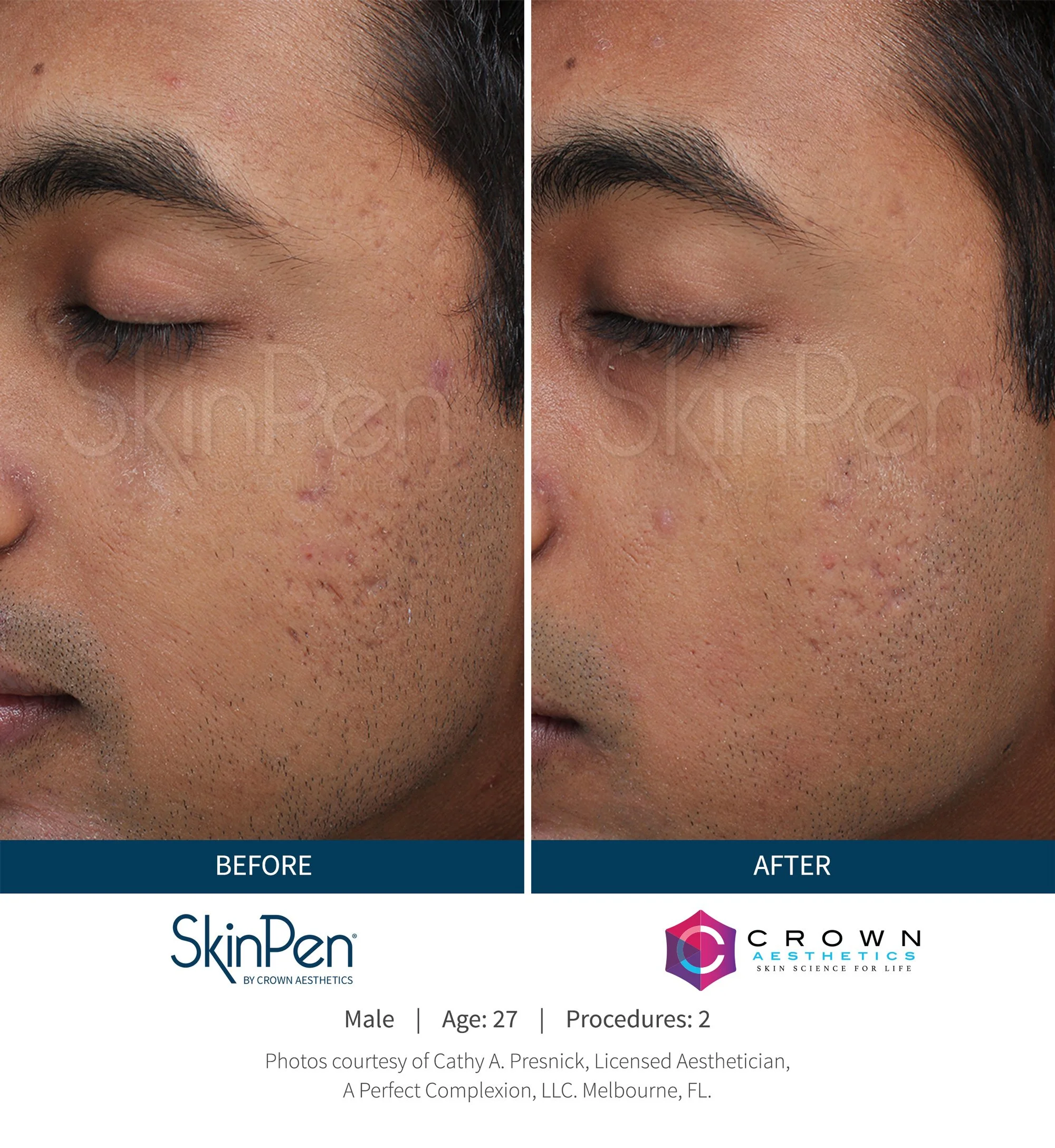 SkinPen_Acne_Melbourne_Male_27_Before-and-After-Picture.jpg