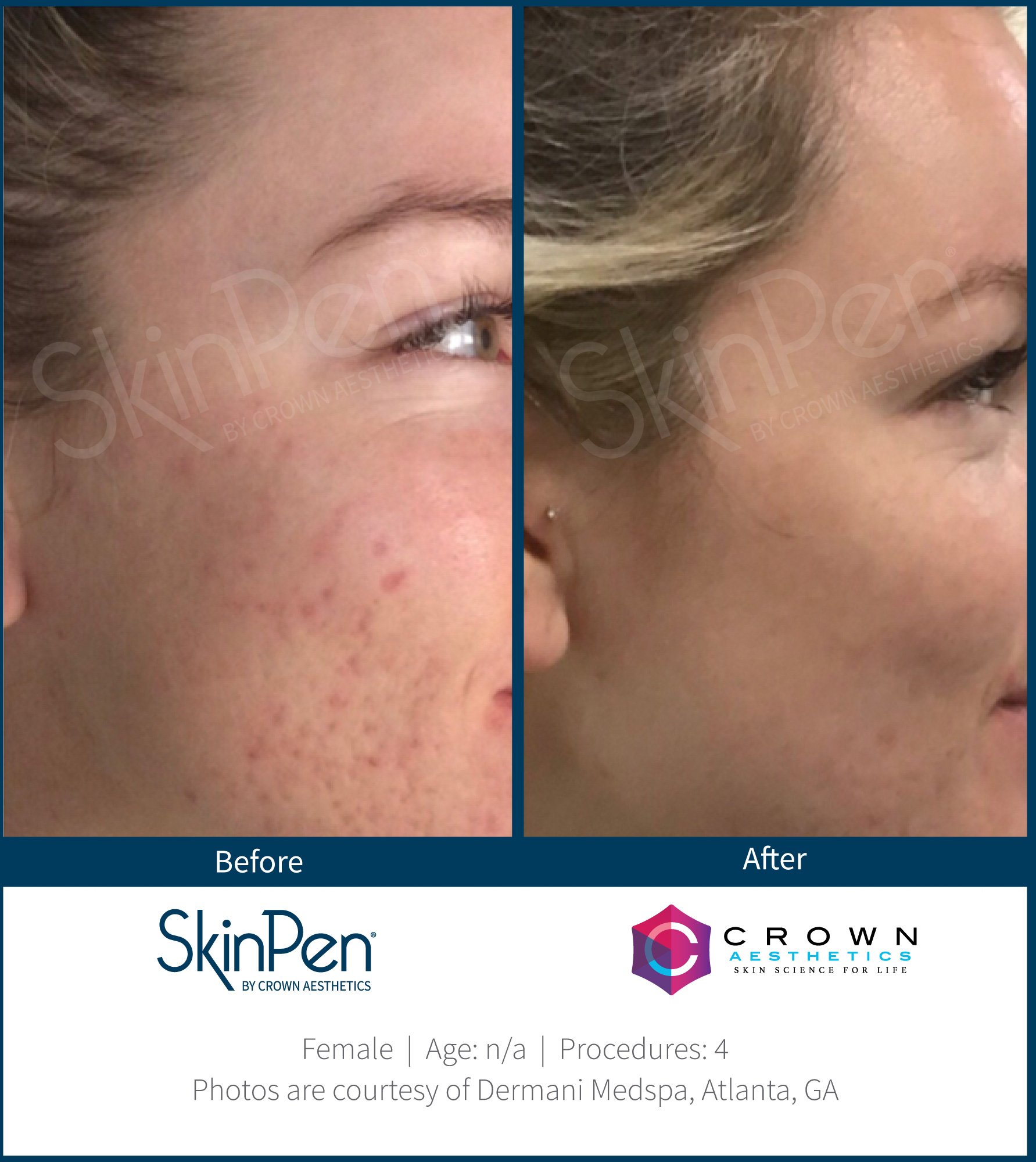 SkinPen_Acne_Atlanta_Female_NA_Before-and-After-Picture_2.jpg