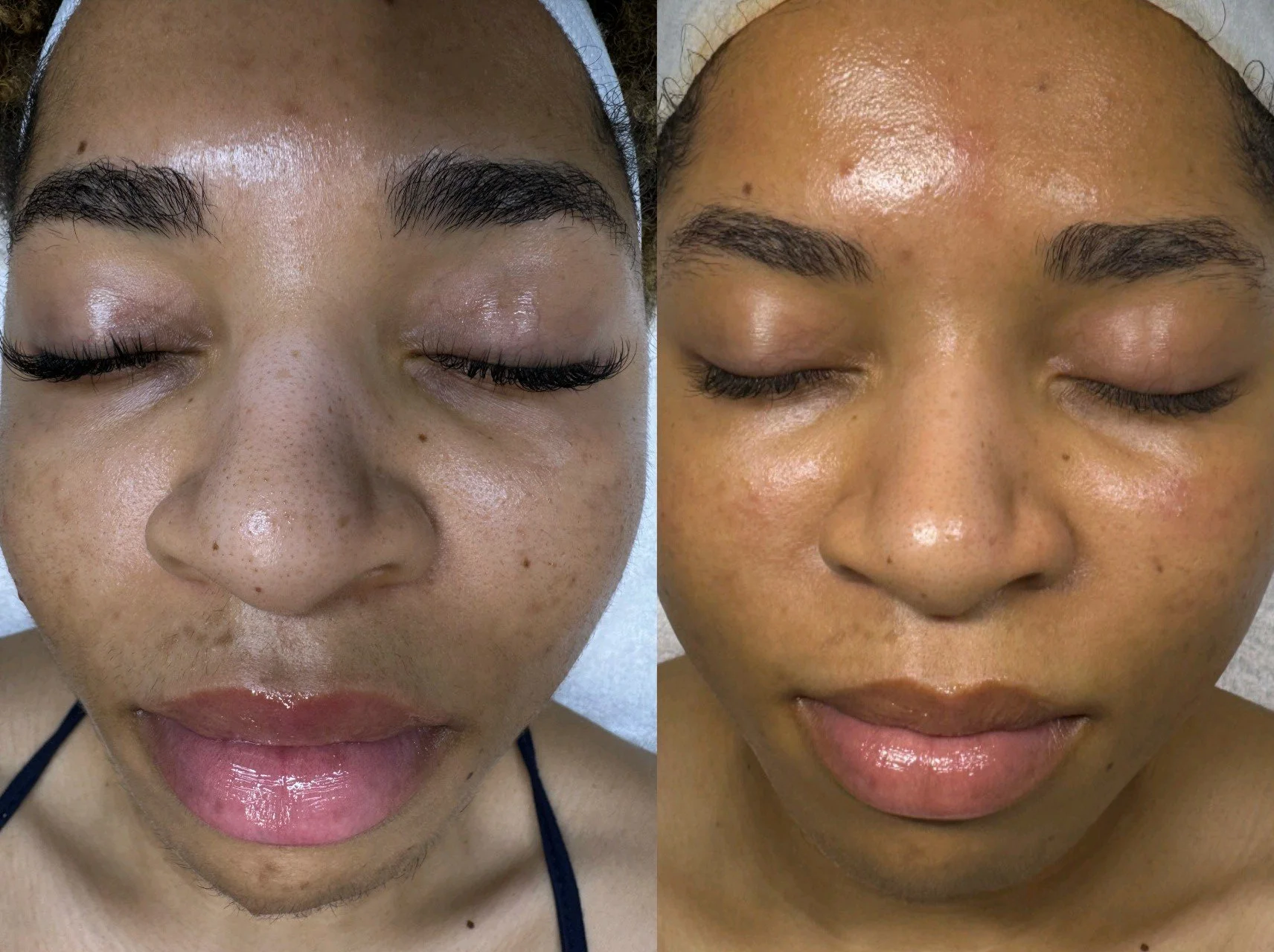 Acne Skin Program (2 Month update)