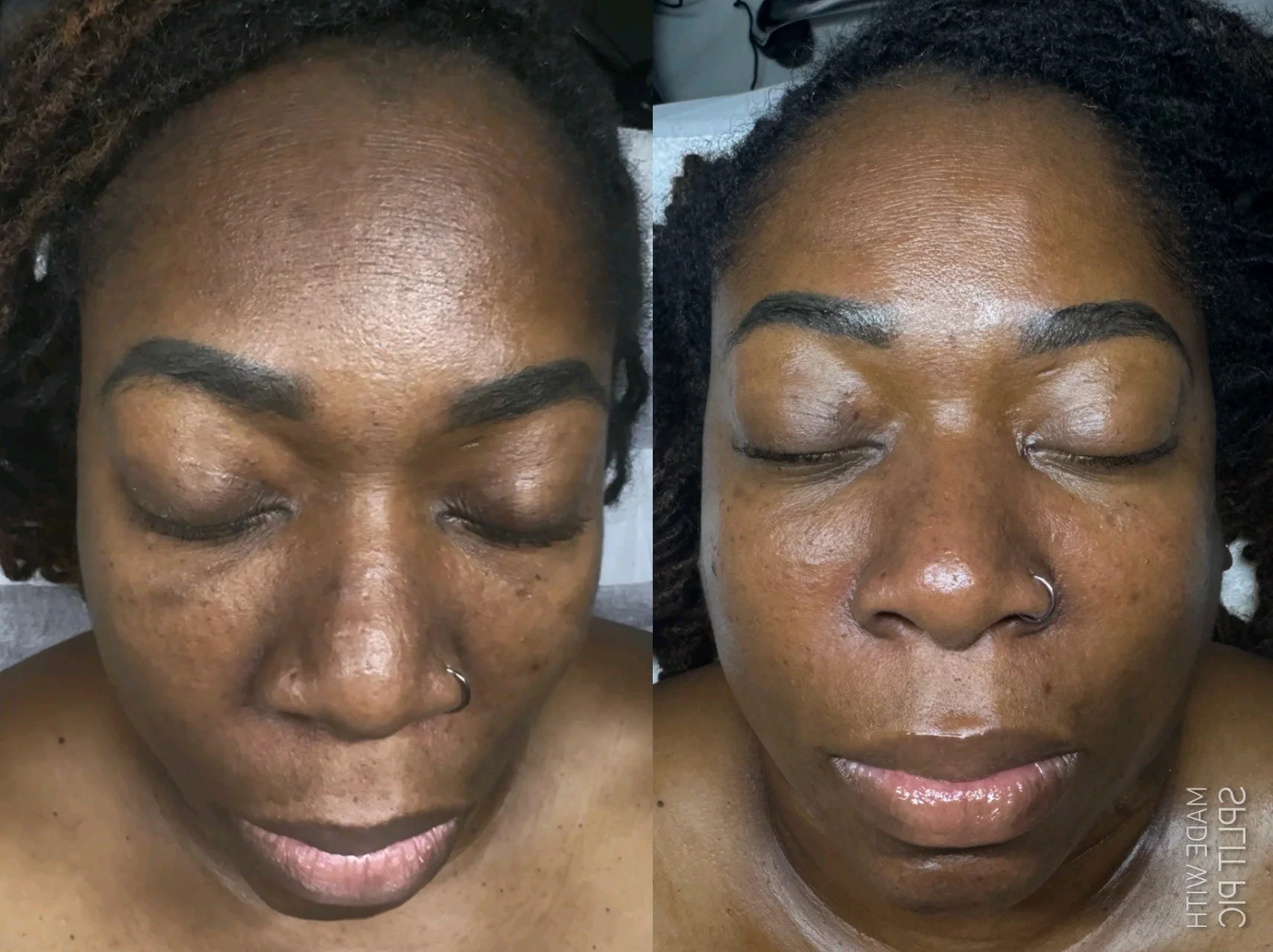 Skin Program Hyperpigmentation (3 Month Update)