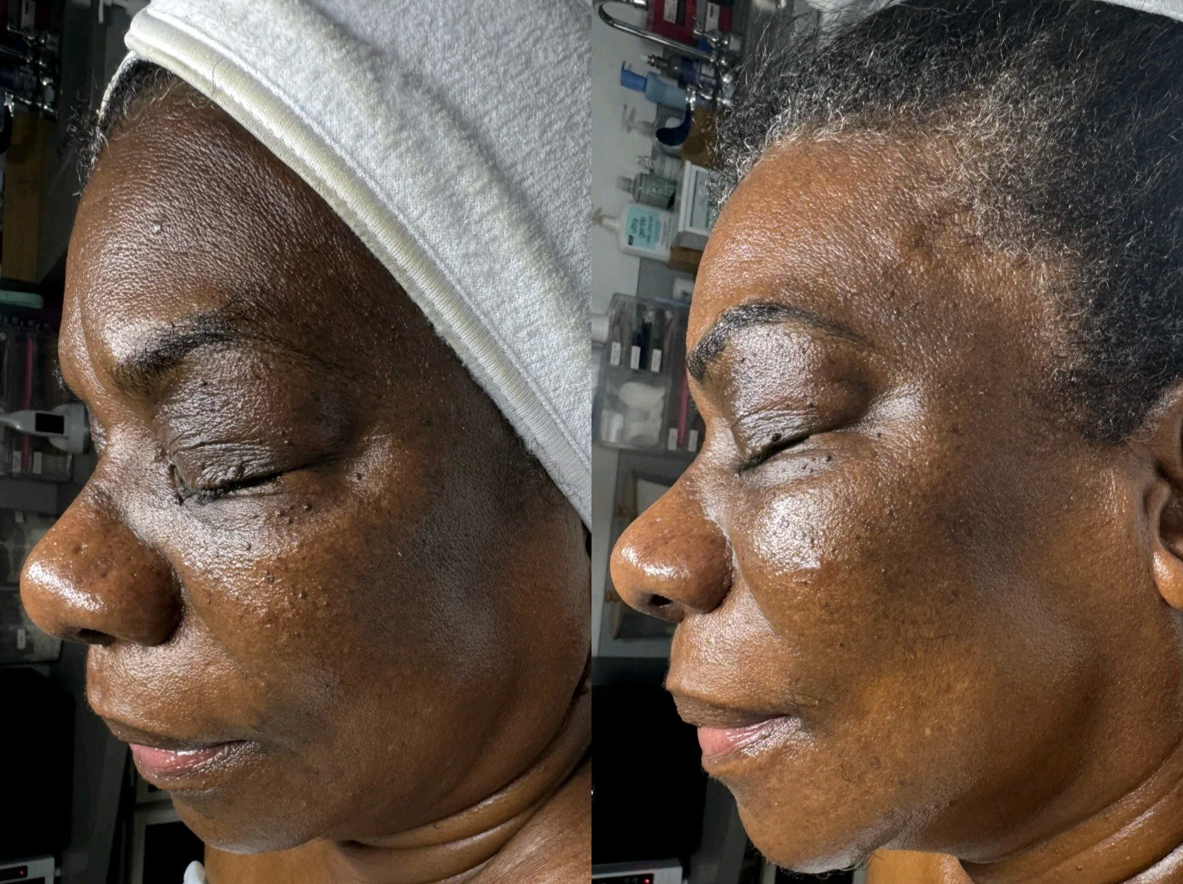 Skin Renewal Membership with Jet Plasma (7 Month Update)