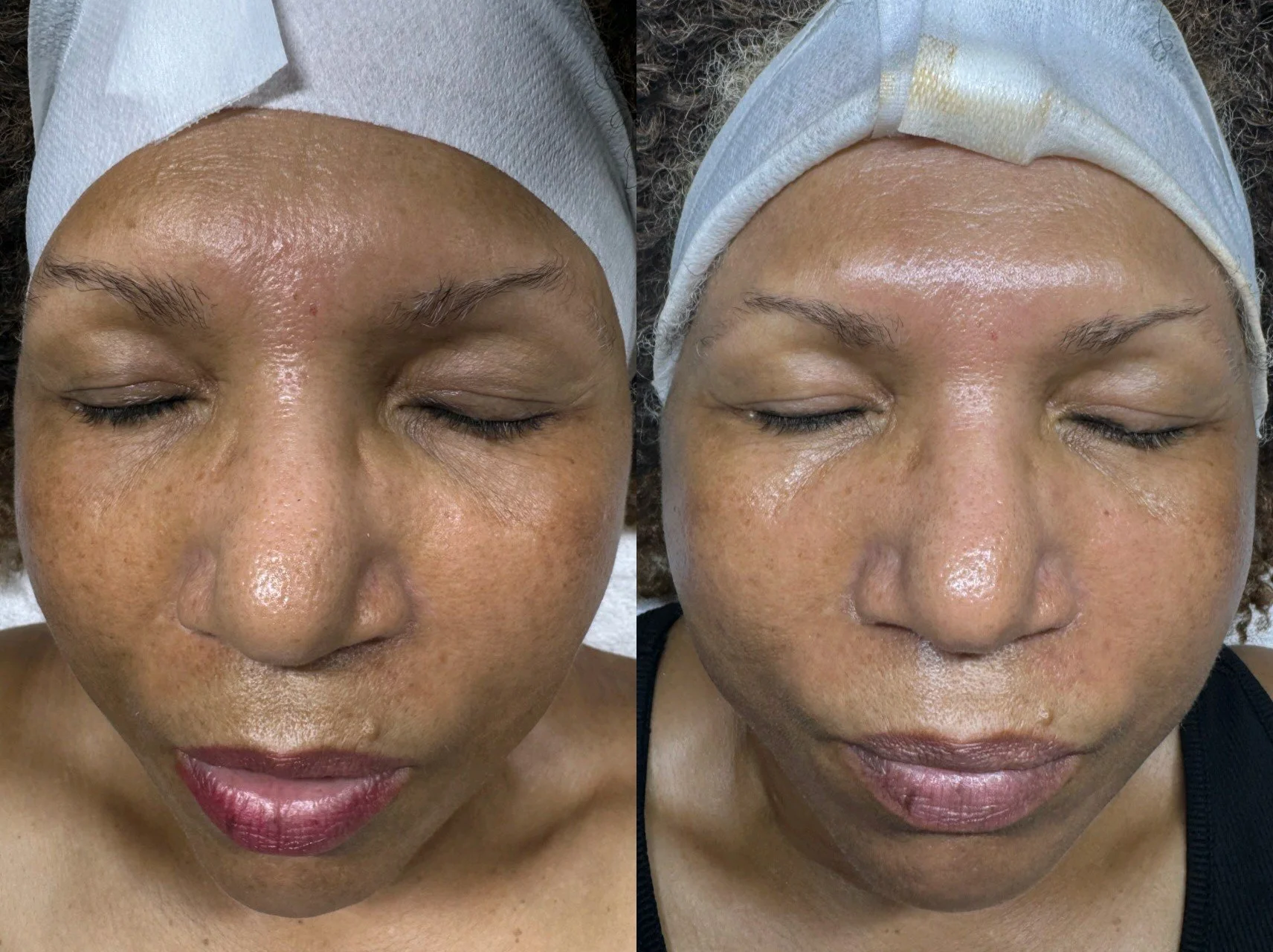 Skin Program Hyperpigmentation/Melasma (3 month update)