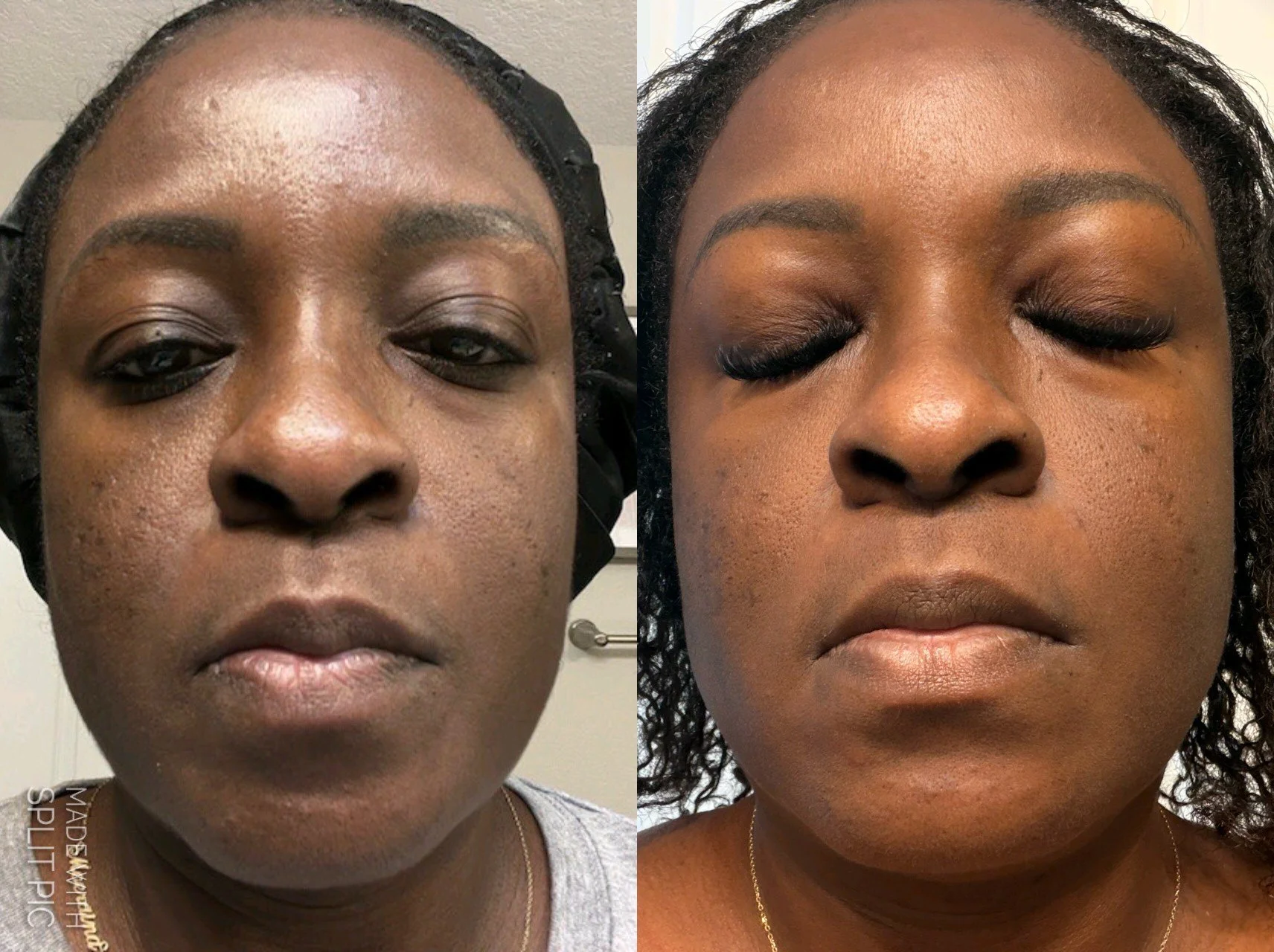Skin program Hyperpigmentation (4 Month)