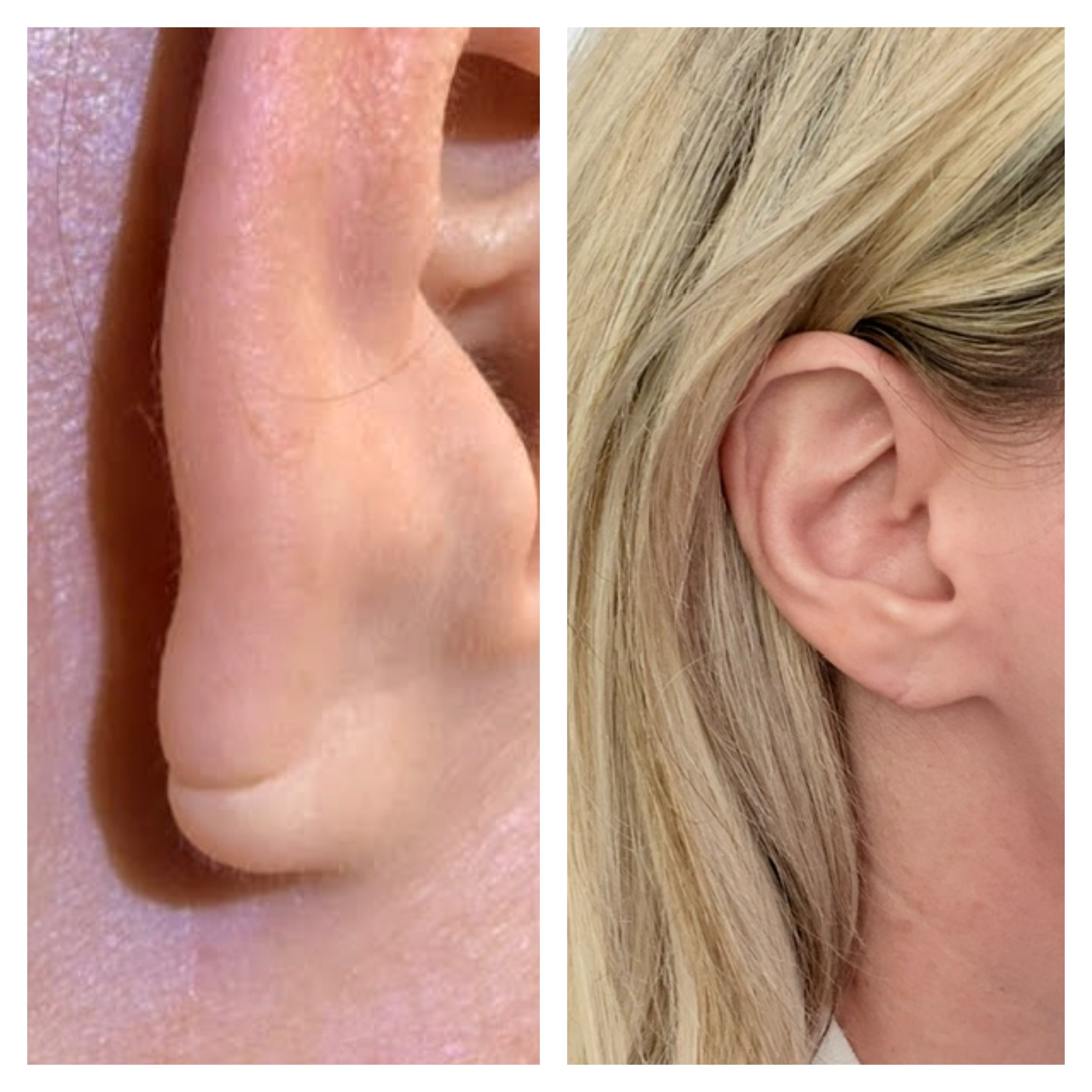 earlobe earring skin cosmetic repair