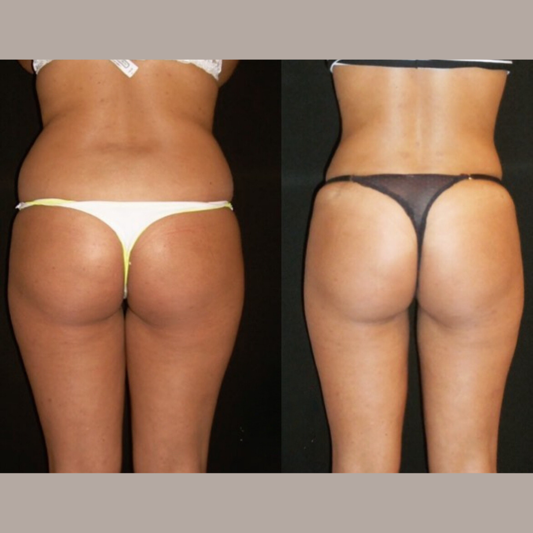 Lipolifting, Pic 7.png