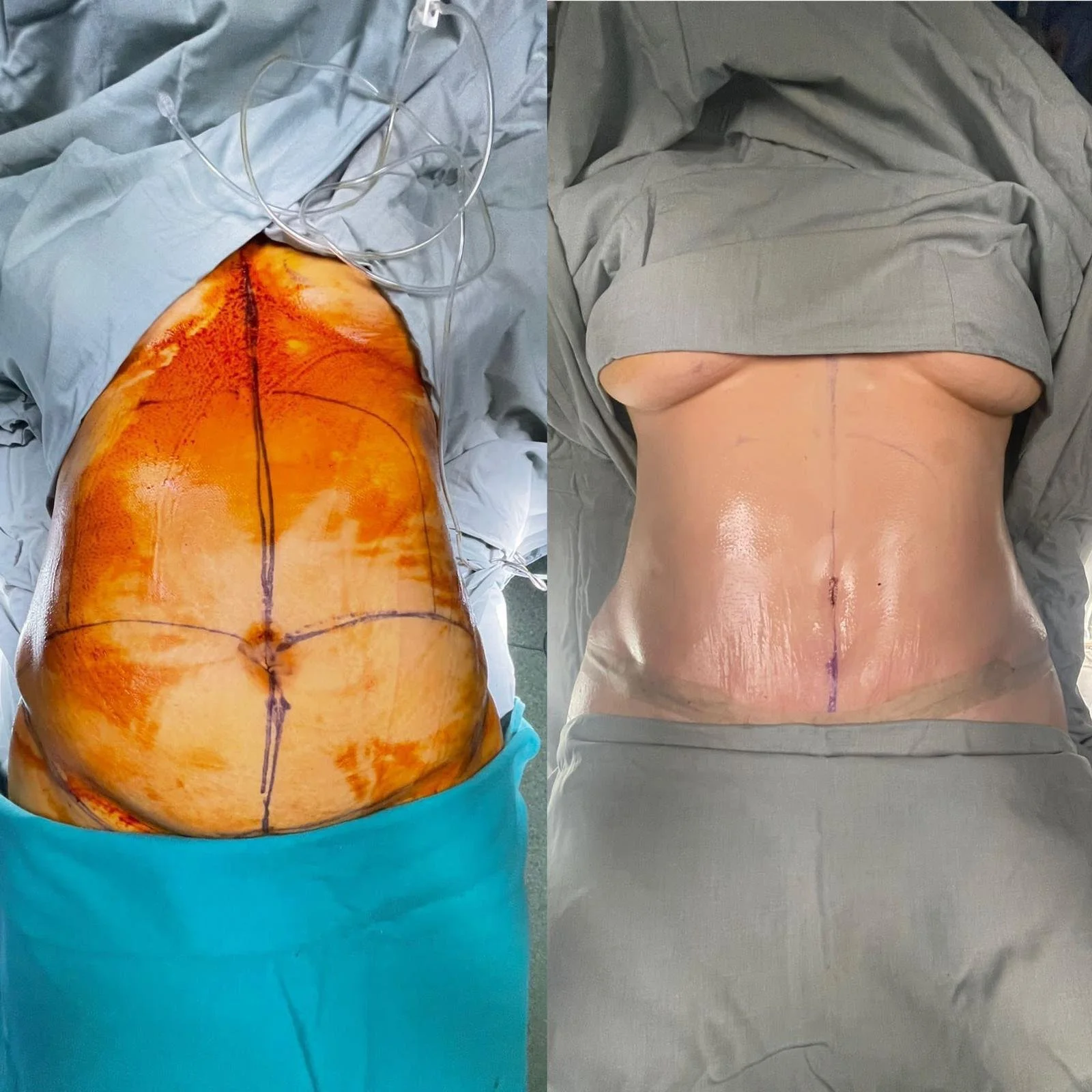Abdominoplasty 1.jpg
