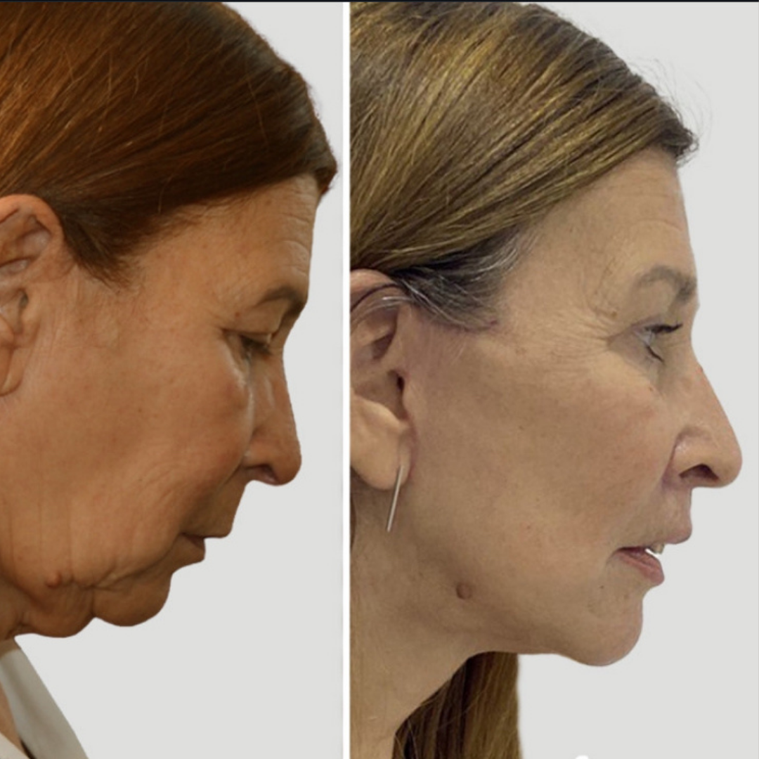 Face Lift, Pic 22.png