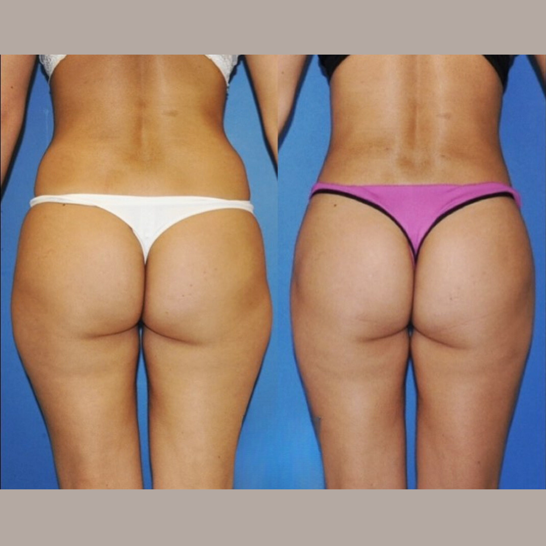 Liposuction, Pic 11.png