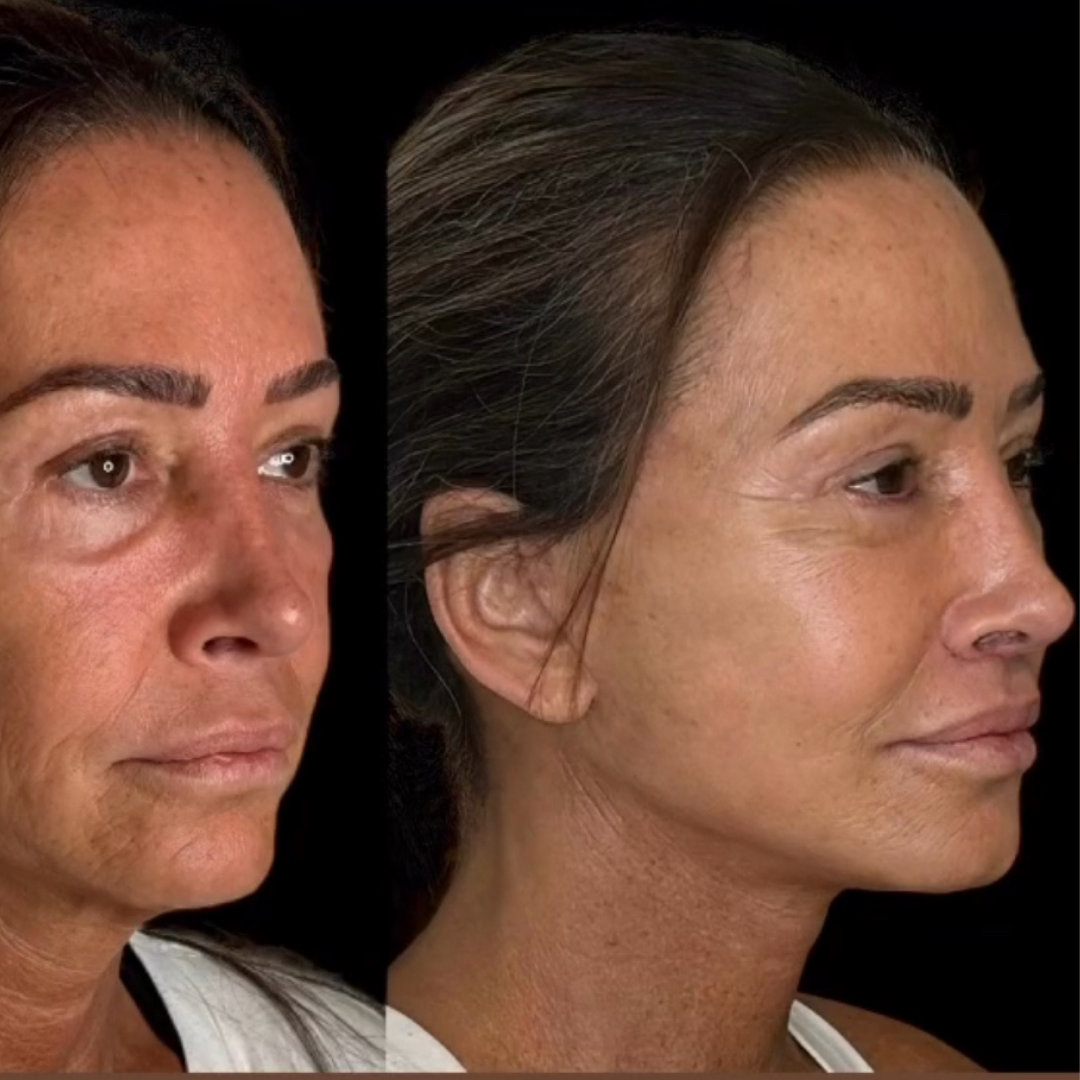 Face Lift, Pic 12.png