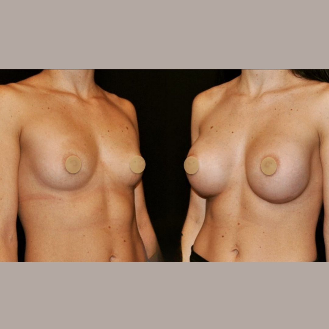 Breast Augmentation, Pic 33.png