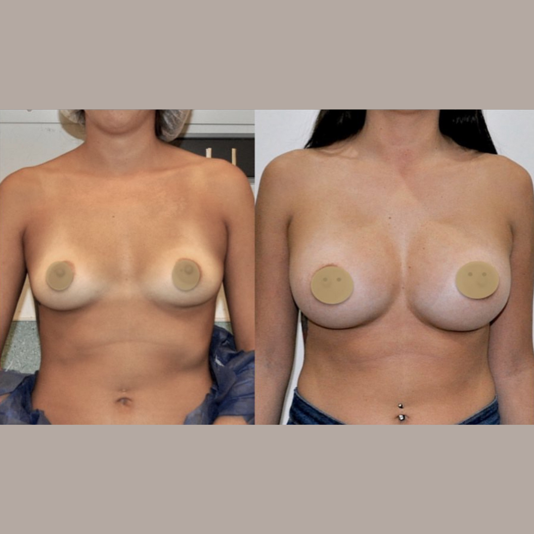 Breast Augmentation, Pic 31.png