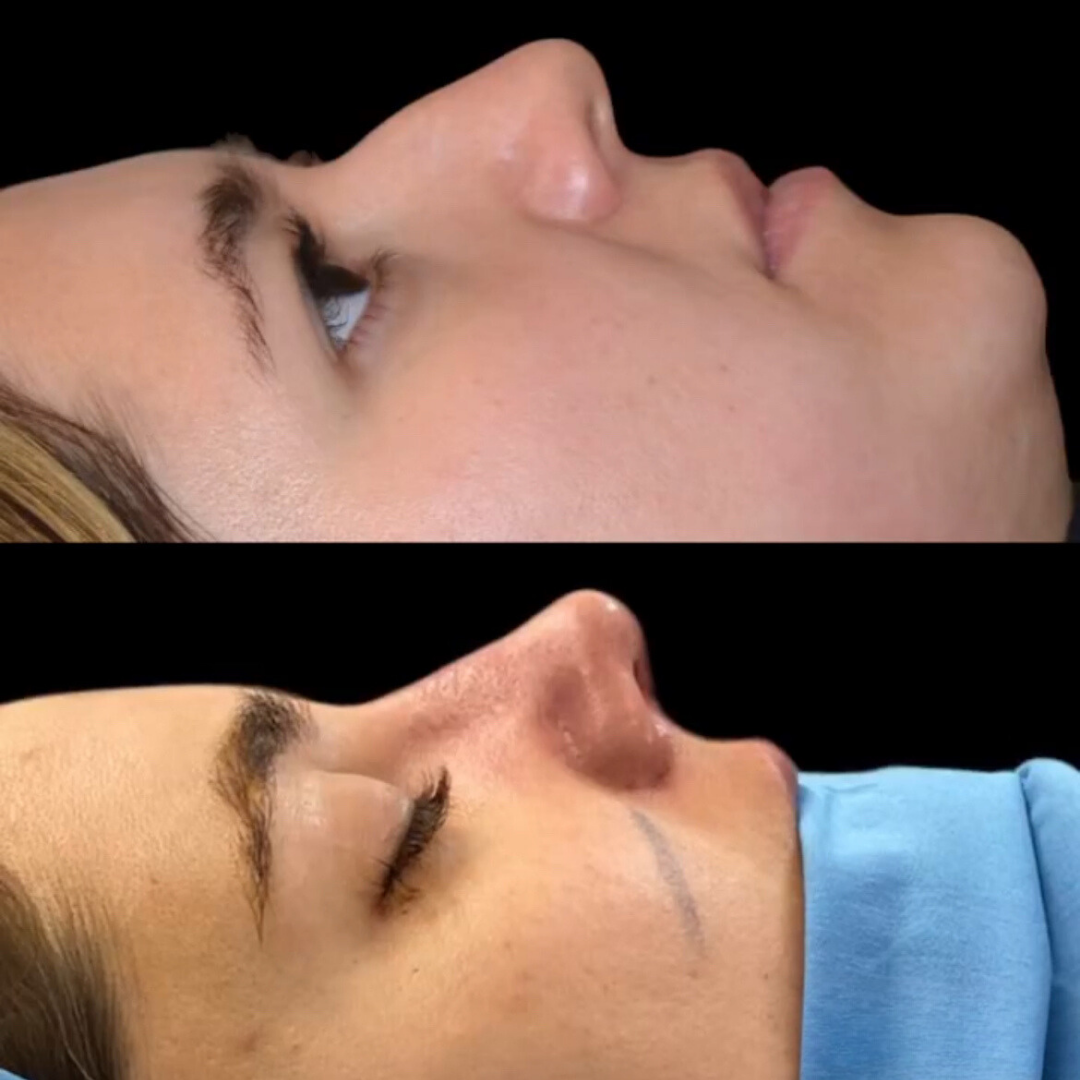 Rhinoplasty with Estedica, Pic 4.png