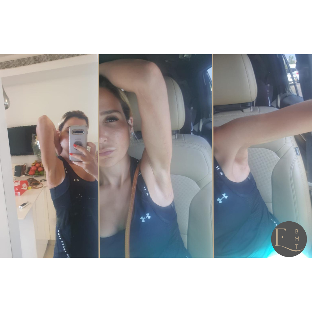 Medical Travel - Arm Lift.png