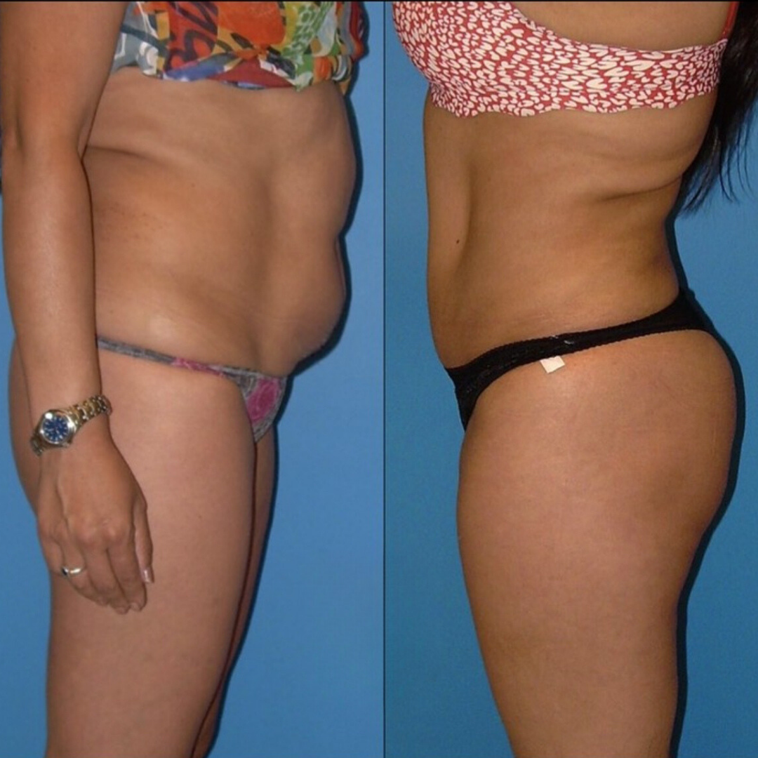 Abdominoplasty, Pic 4.png