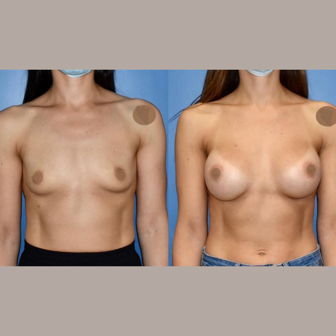 Breast Augmentation, Pic 19.png
