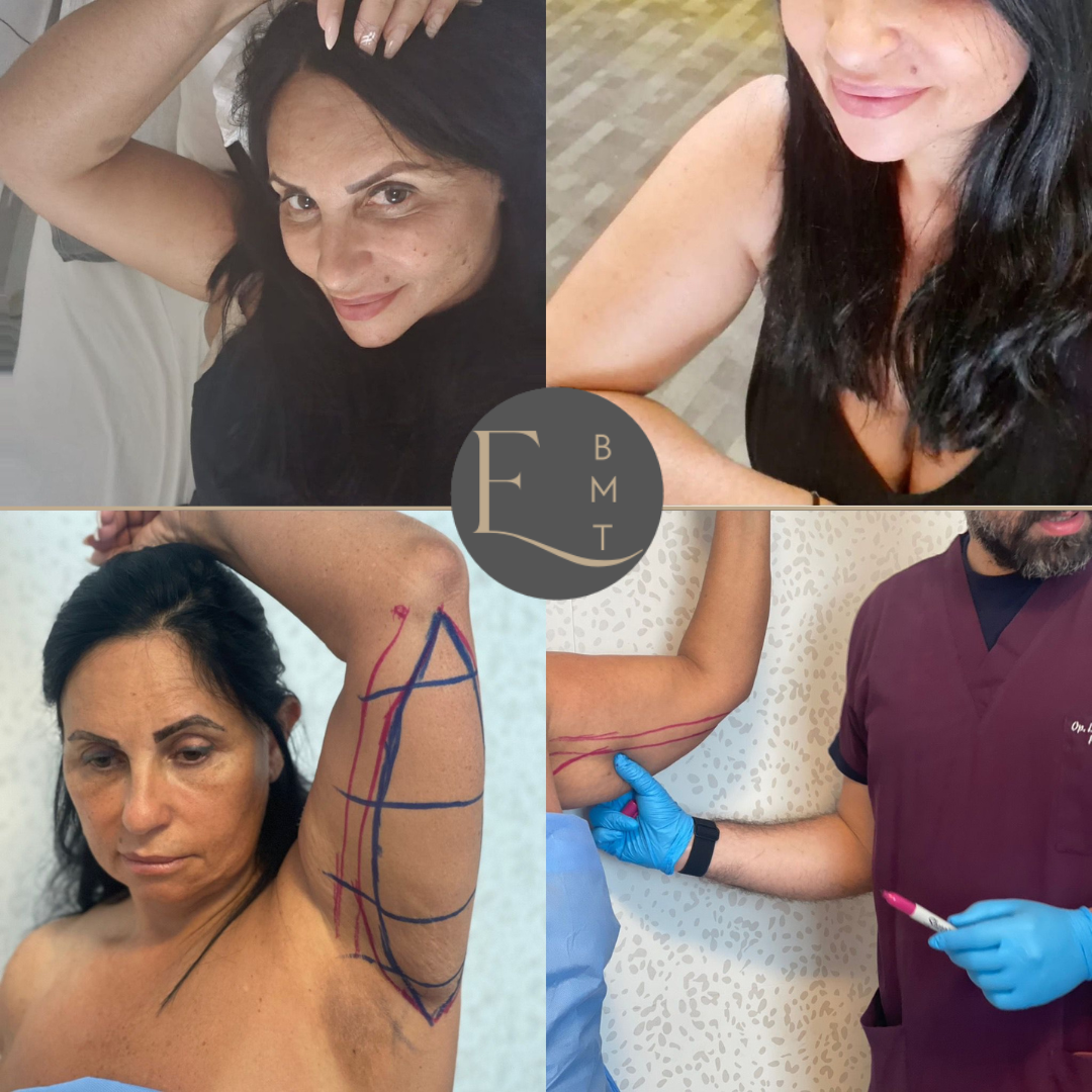 Arm Lift Surgery Overseas.png