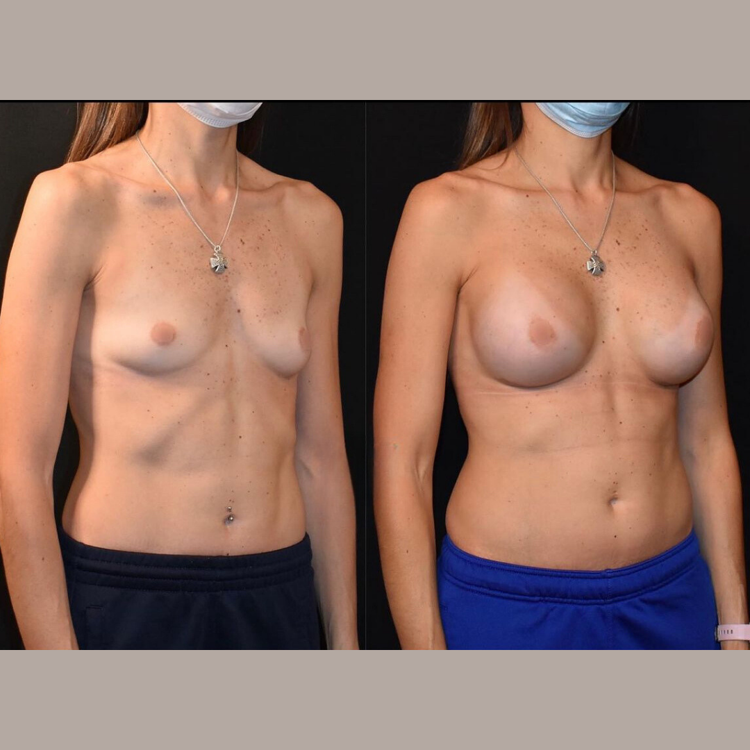 Breast Augmentation, Pic 22.png