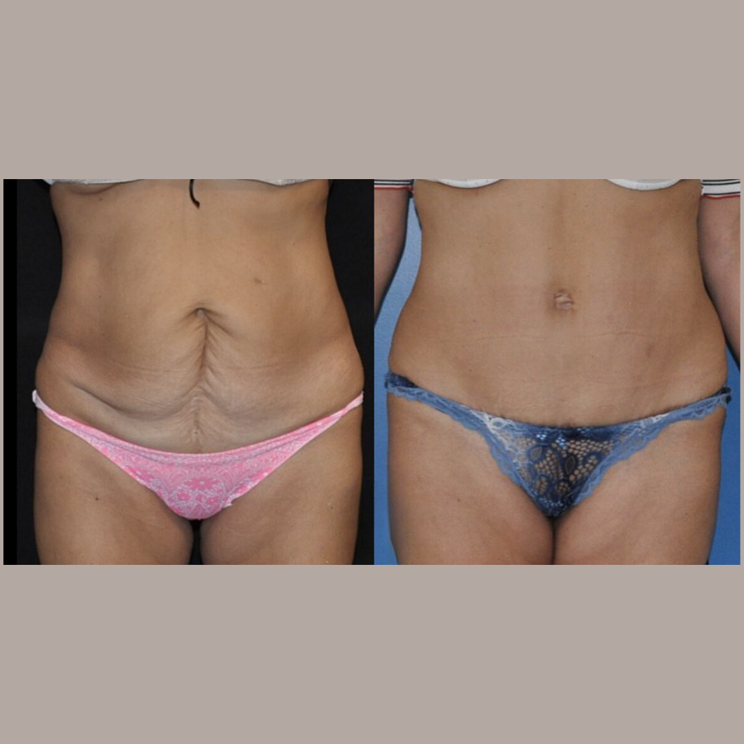 Abdominoplasty, Pic 7.png