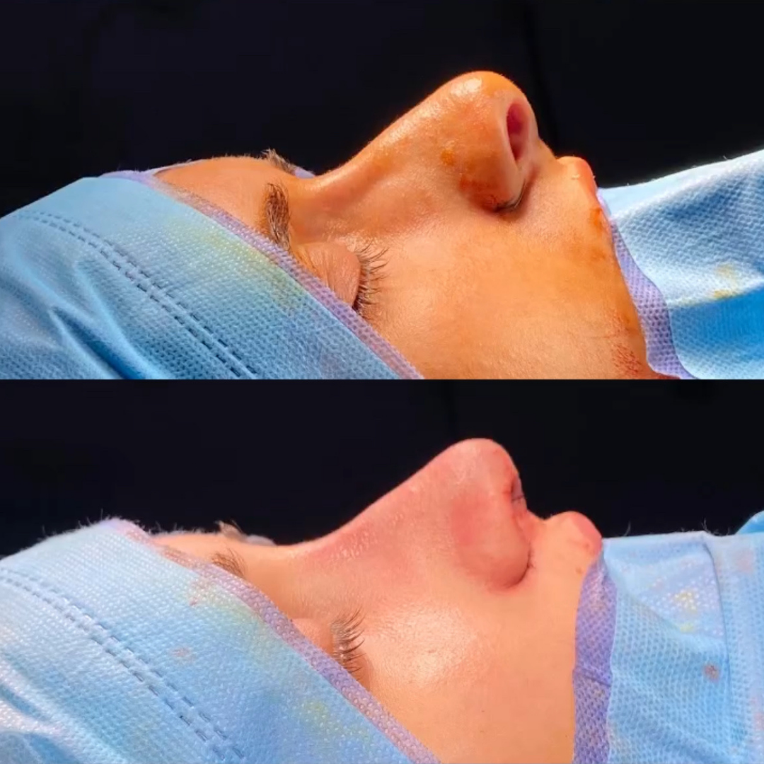 Rhinoplasty in Argentina, pic 7.png
