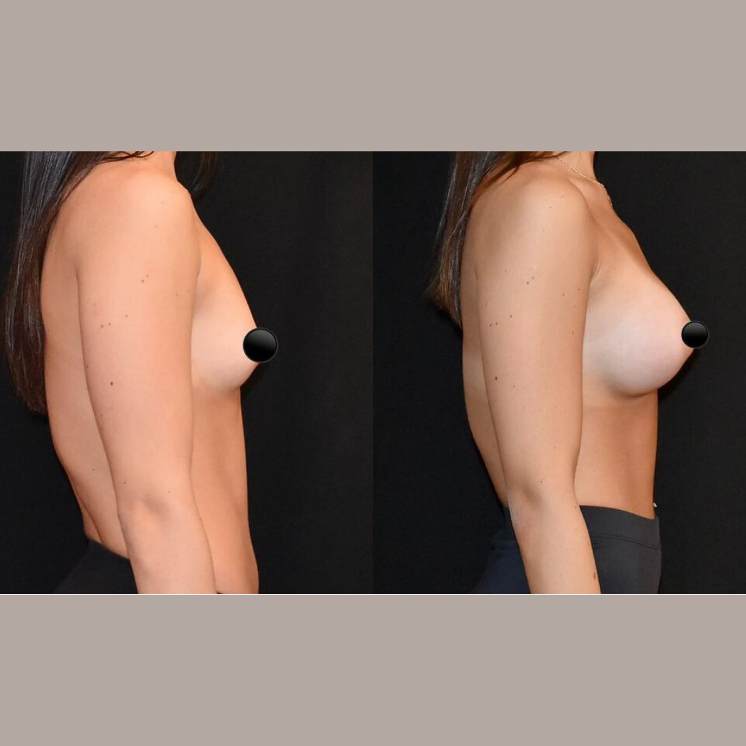 Breast Augmentation, Pic 11.png
