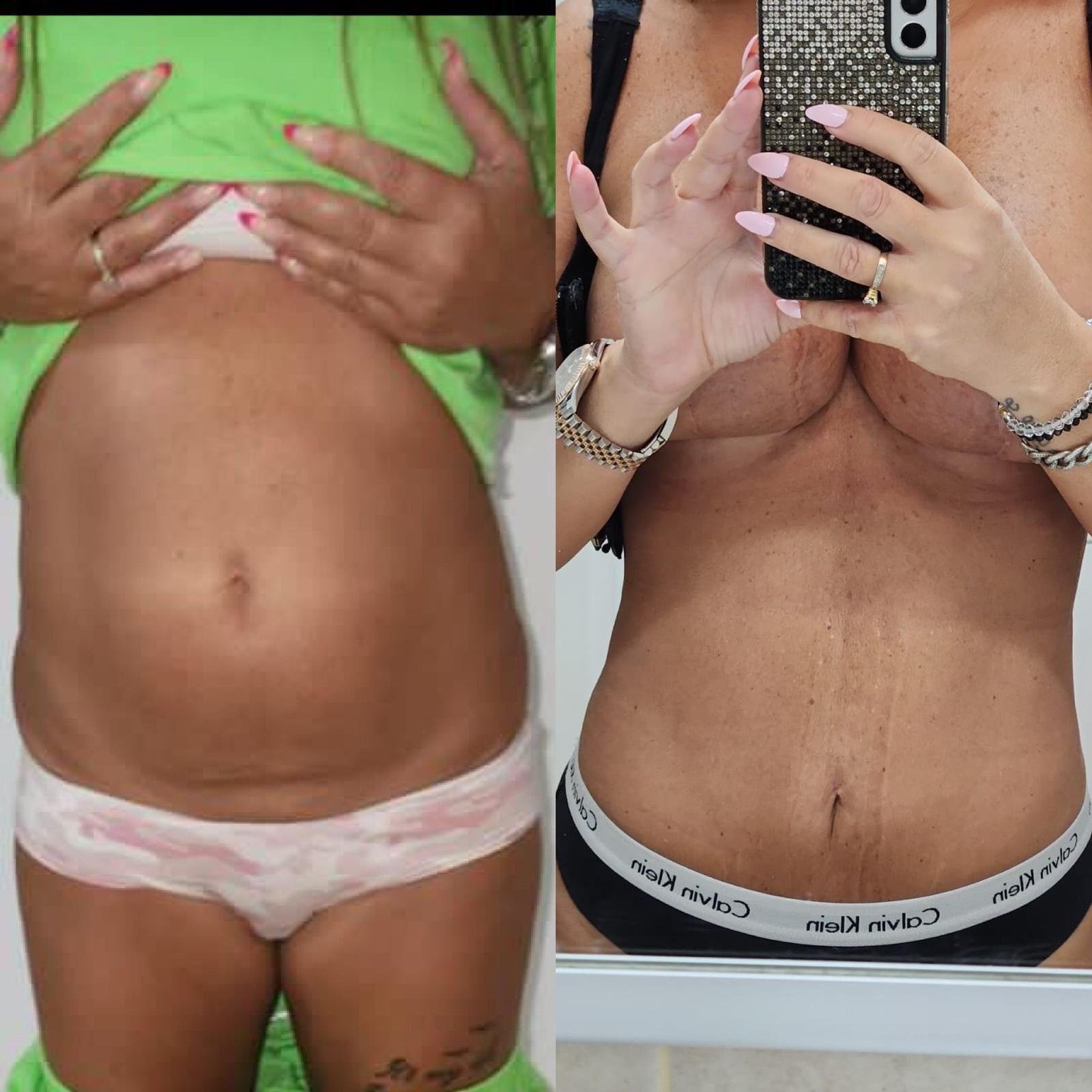 Abdominoplasty 2.jpg