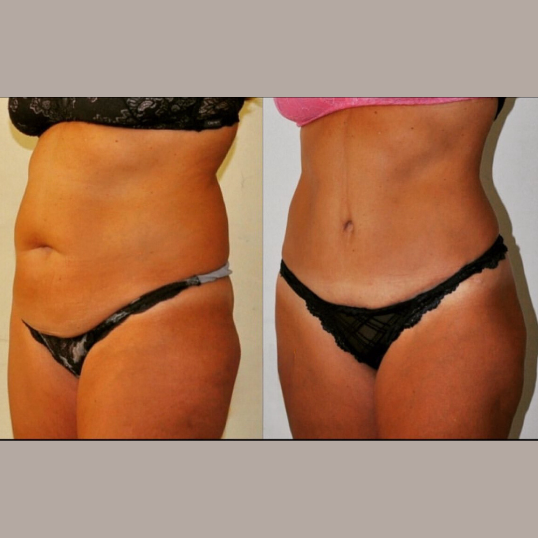 Liposuction, Pic 9.png