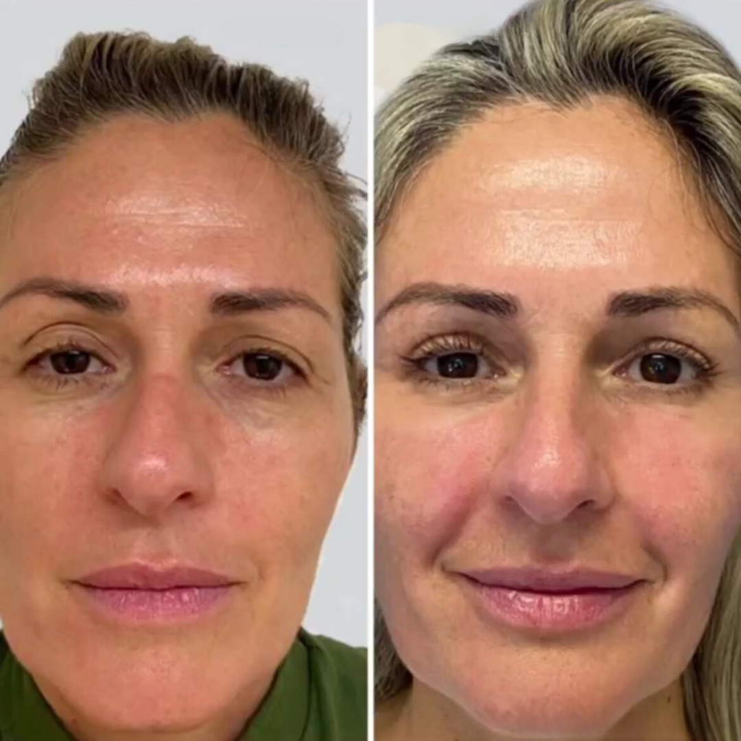 Blepharoplasty, Pic 6.png