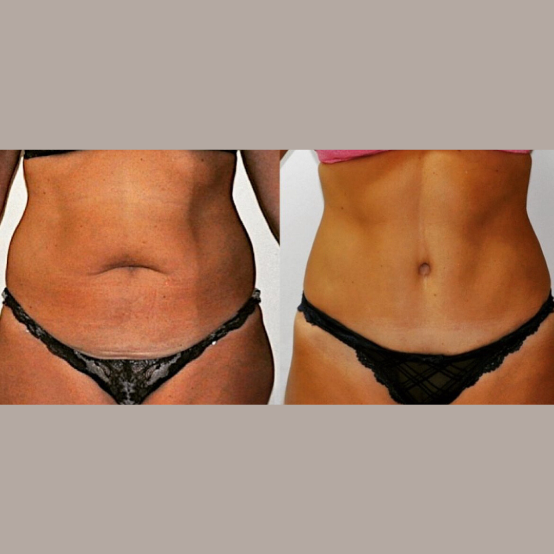 Liposuction, Pic 8.png