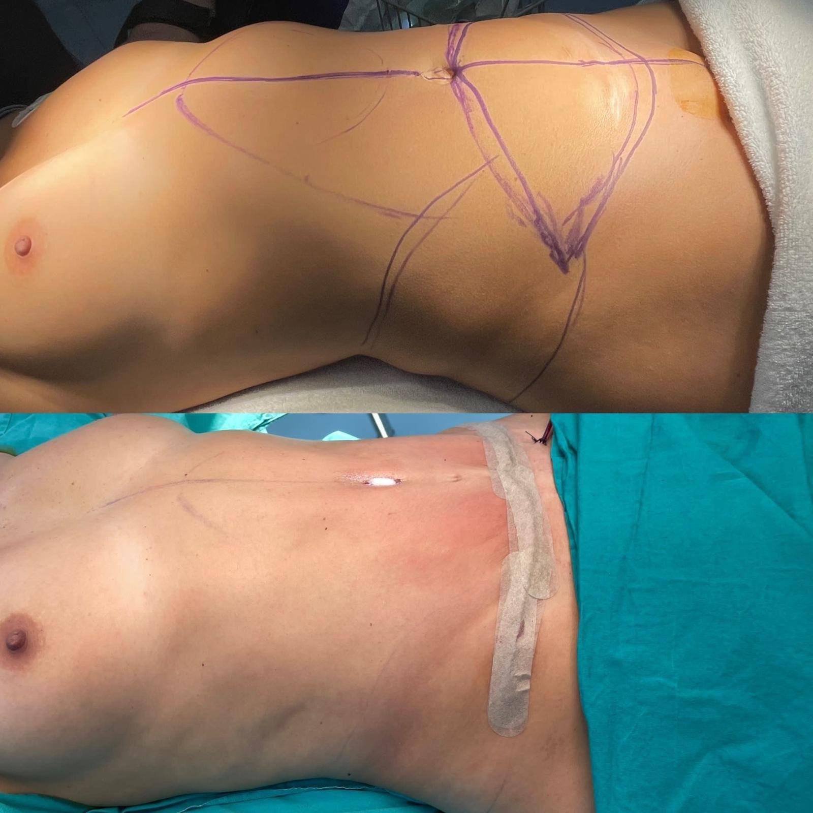 Abdominoplasty 4.jpg