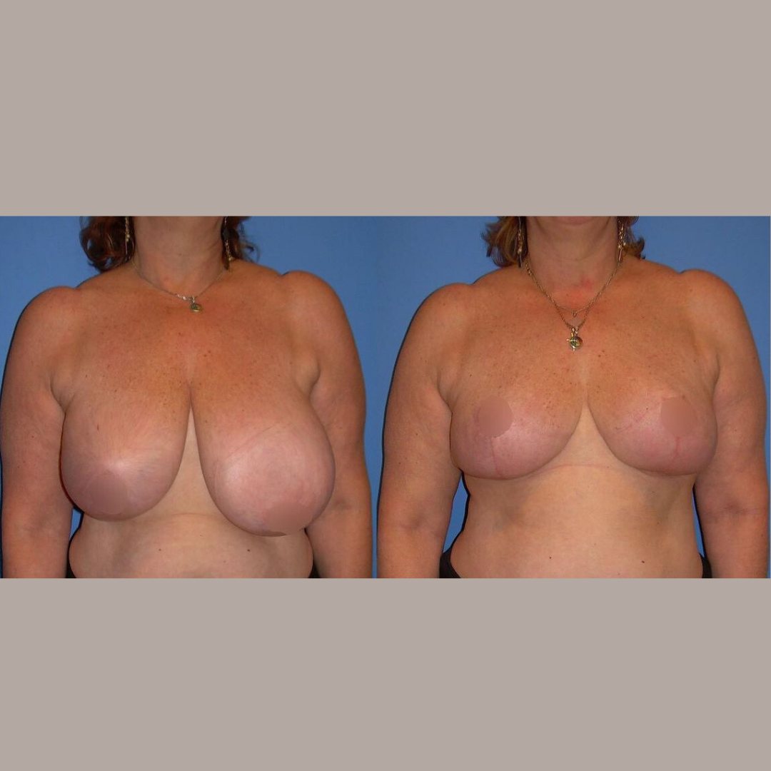 Breast Reduction, Pic 1.png