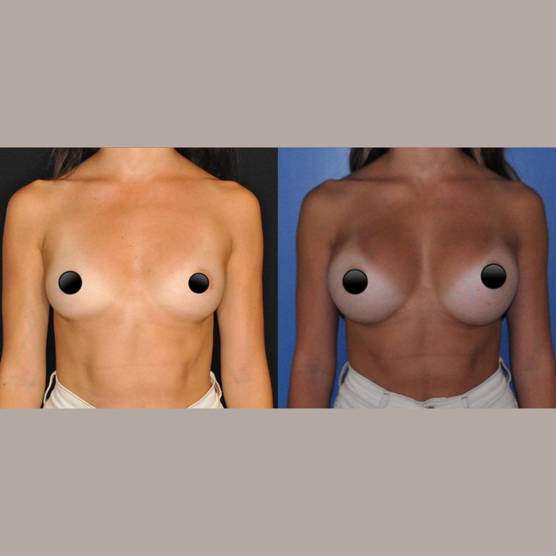 Breast Augmentation, Pic 21.png