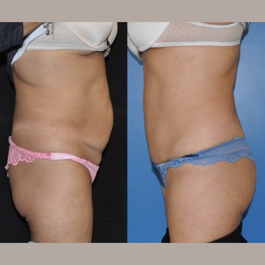 Abdominoplasty, Pic 9.png