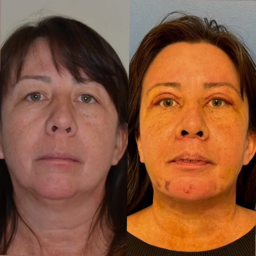 Face Lift, Pic 17.png