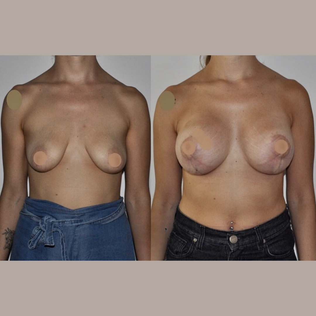 Breast Lift and Augmentation, Pic 1.png