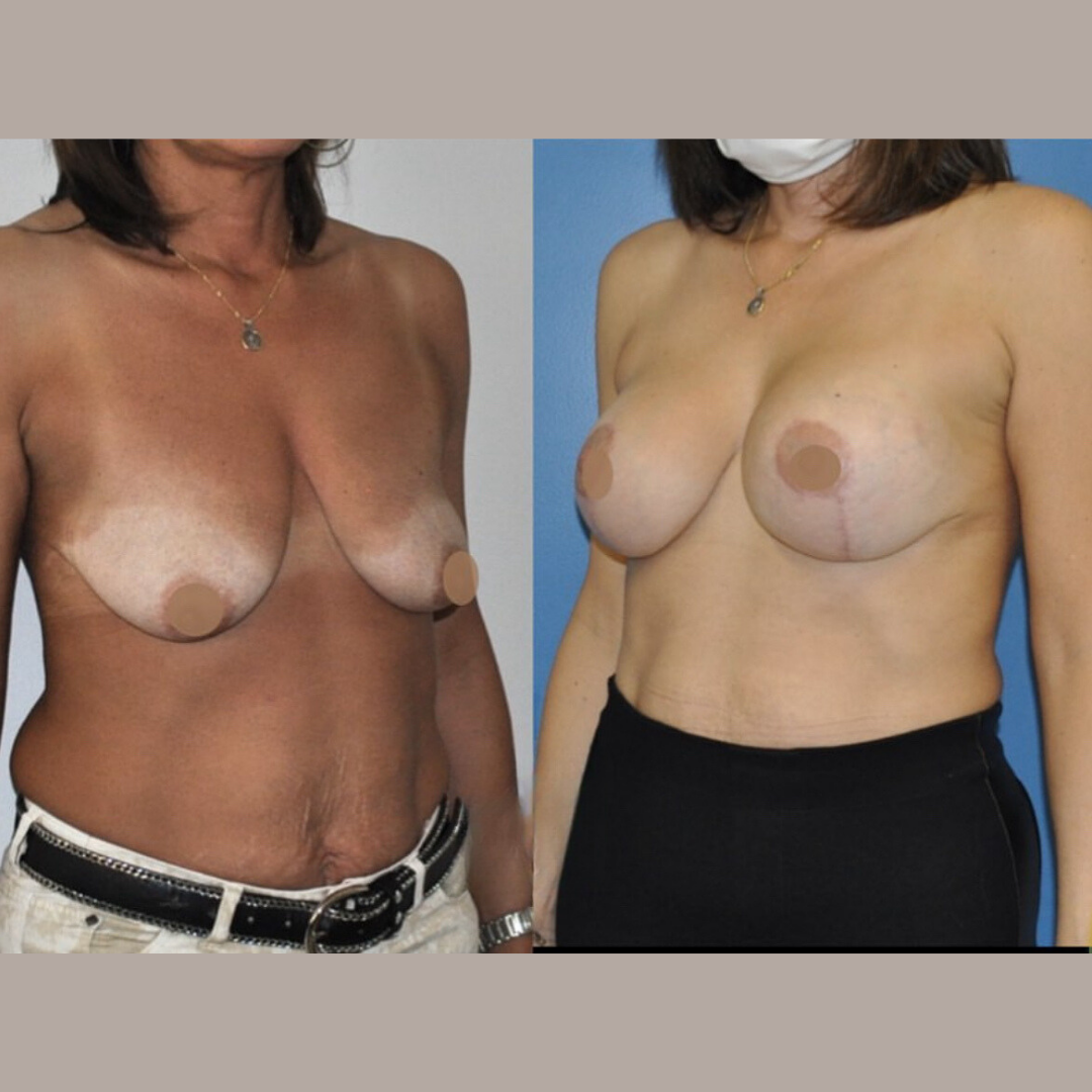 Breast Lift and Augmentation, Pic 4.png