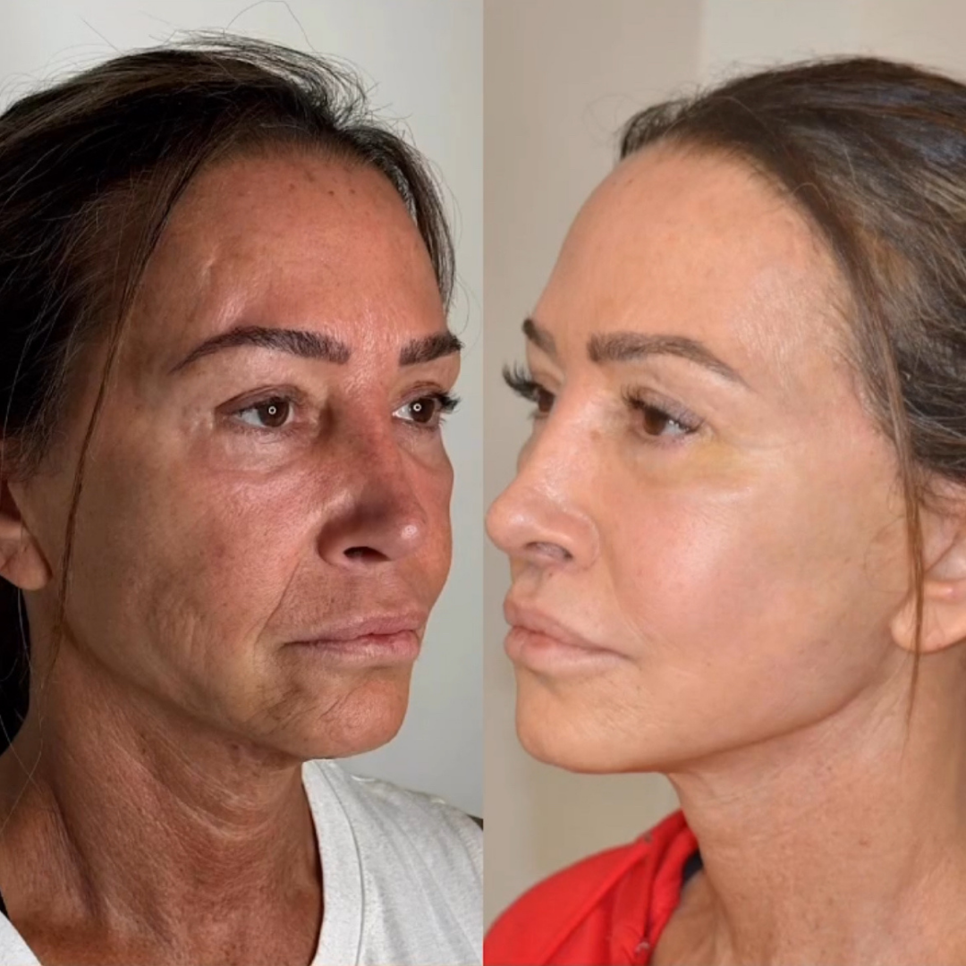 Face Lift, Pic 15.png