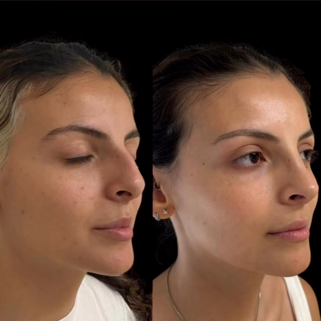 Rhinoplasty with Estedica, Pic 8.png