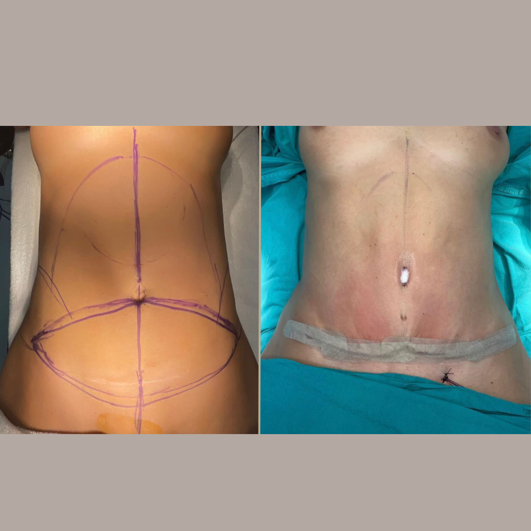 Abdominoplasty 7.png