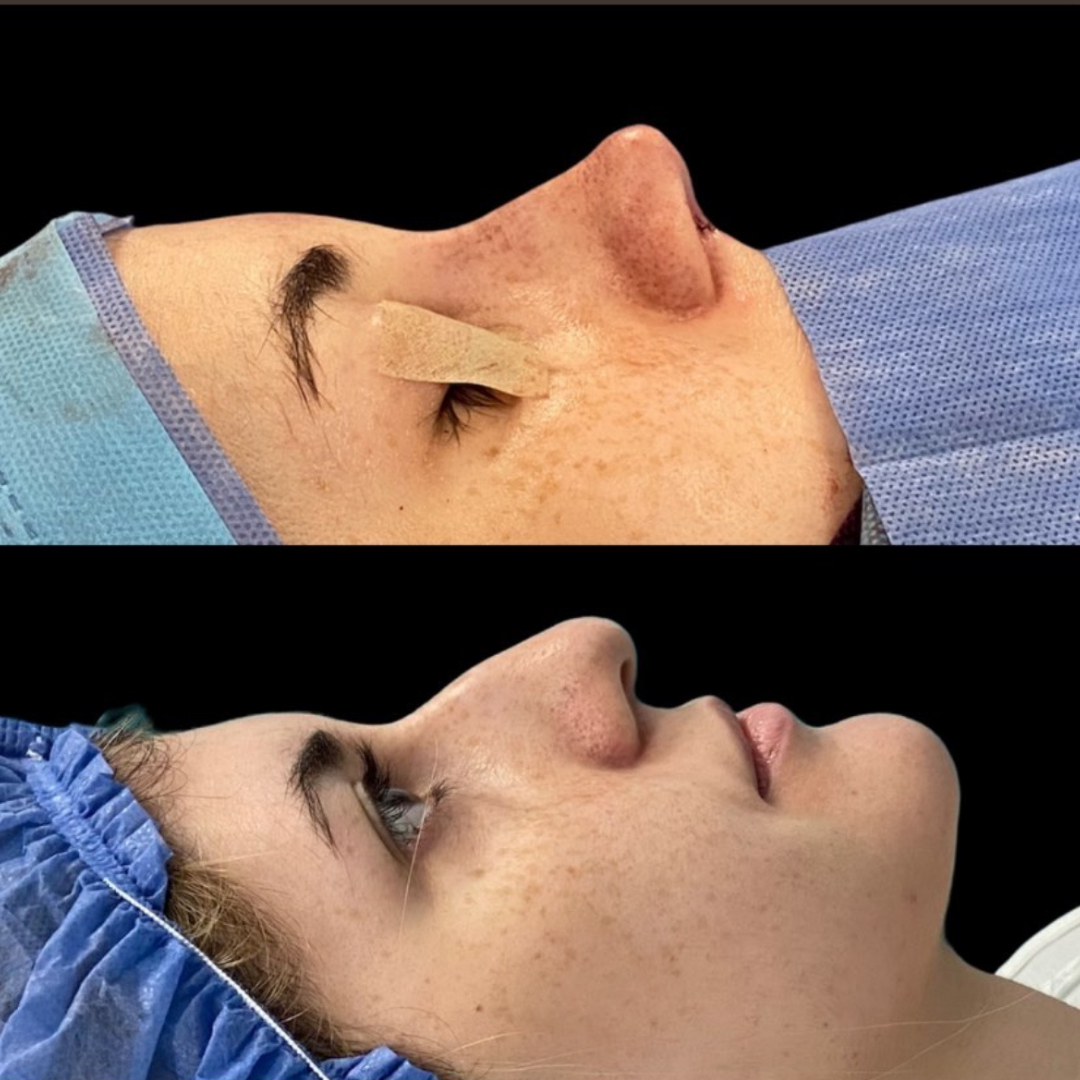 Rhinoplasty in Argentina, Pic 1.png